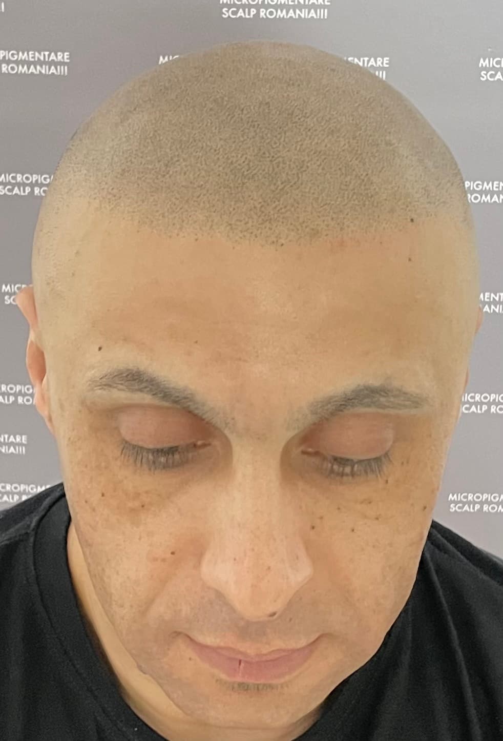 După micropigmentare scalp - Alopecie Androgenetică