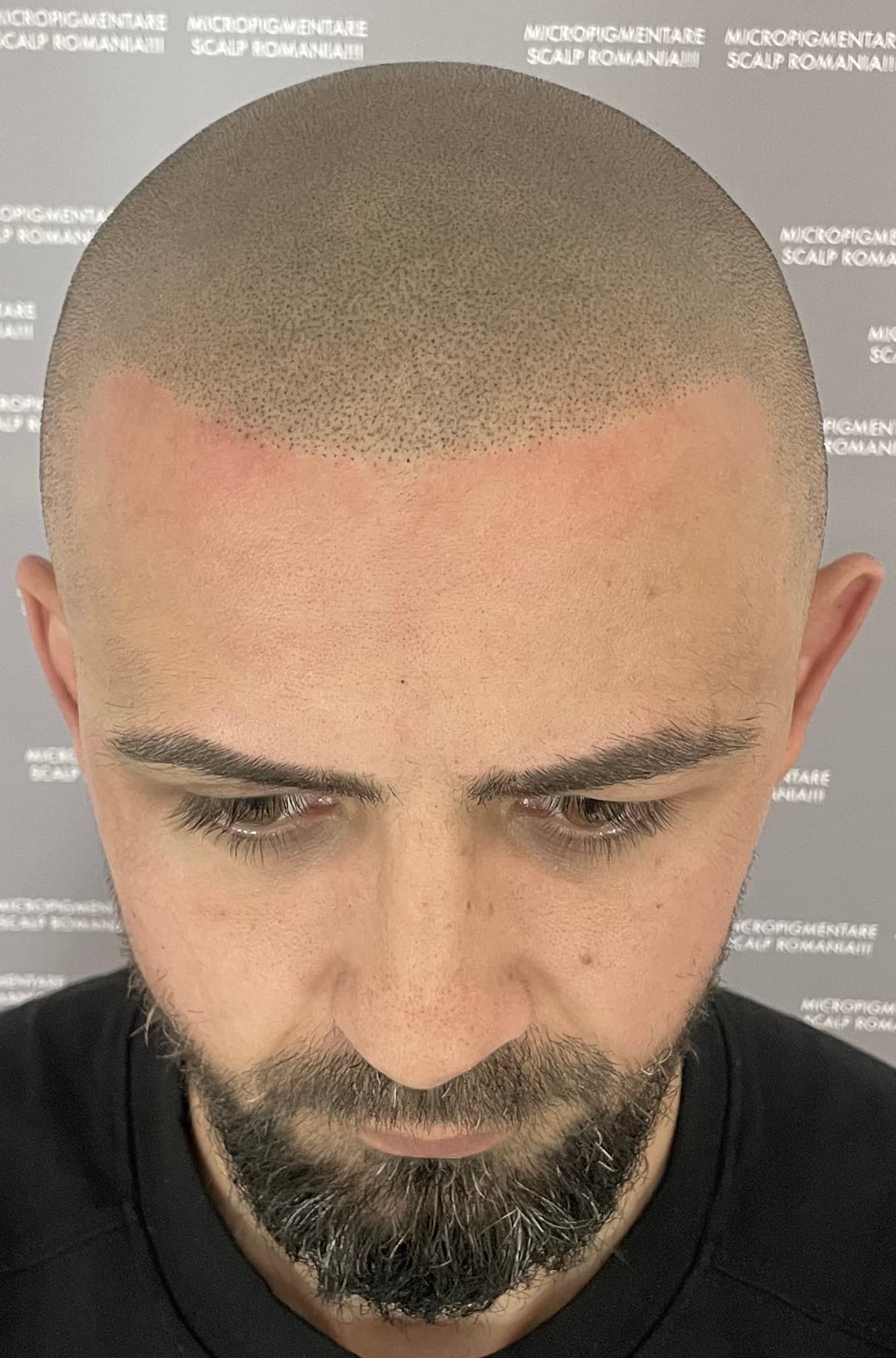 După micropigmentare scalp - Alopecie Androgenetică