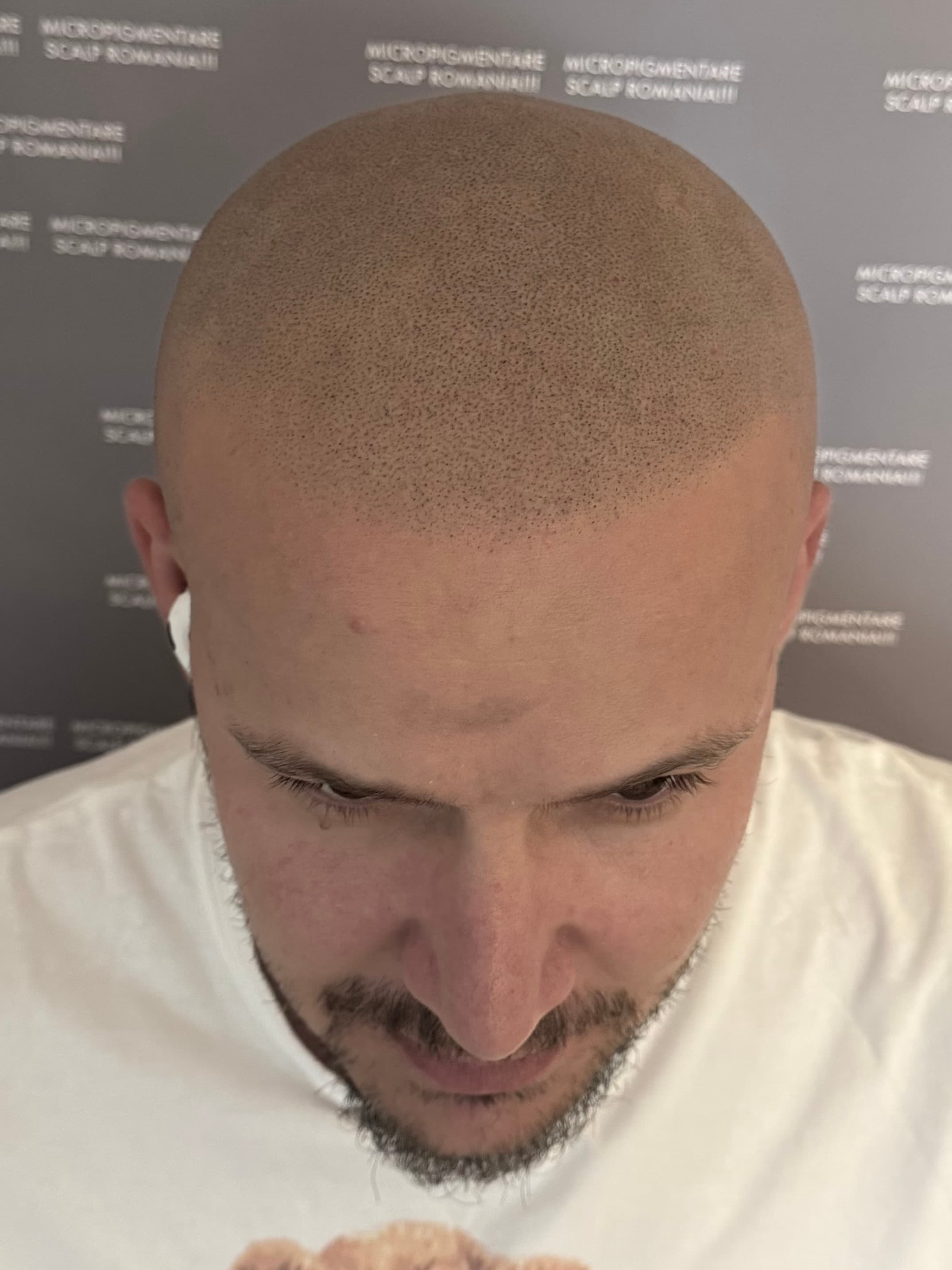 După micropigmentare scalp - Alopecie Androgenetică