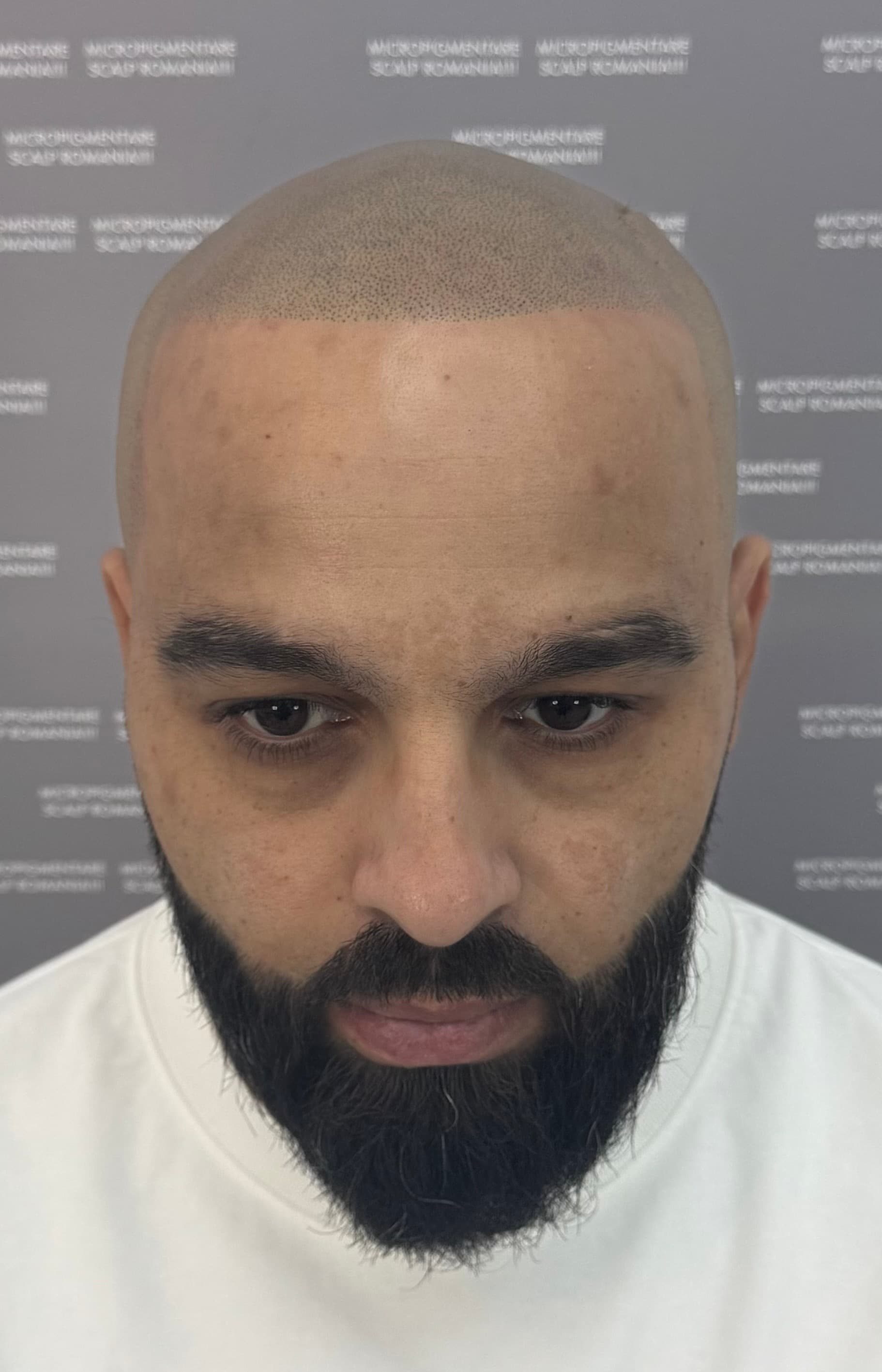 După micropigmentare scalp - Alopecie Androgenetică