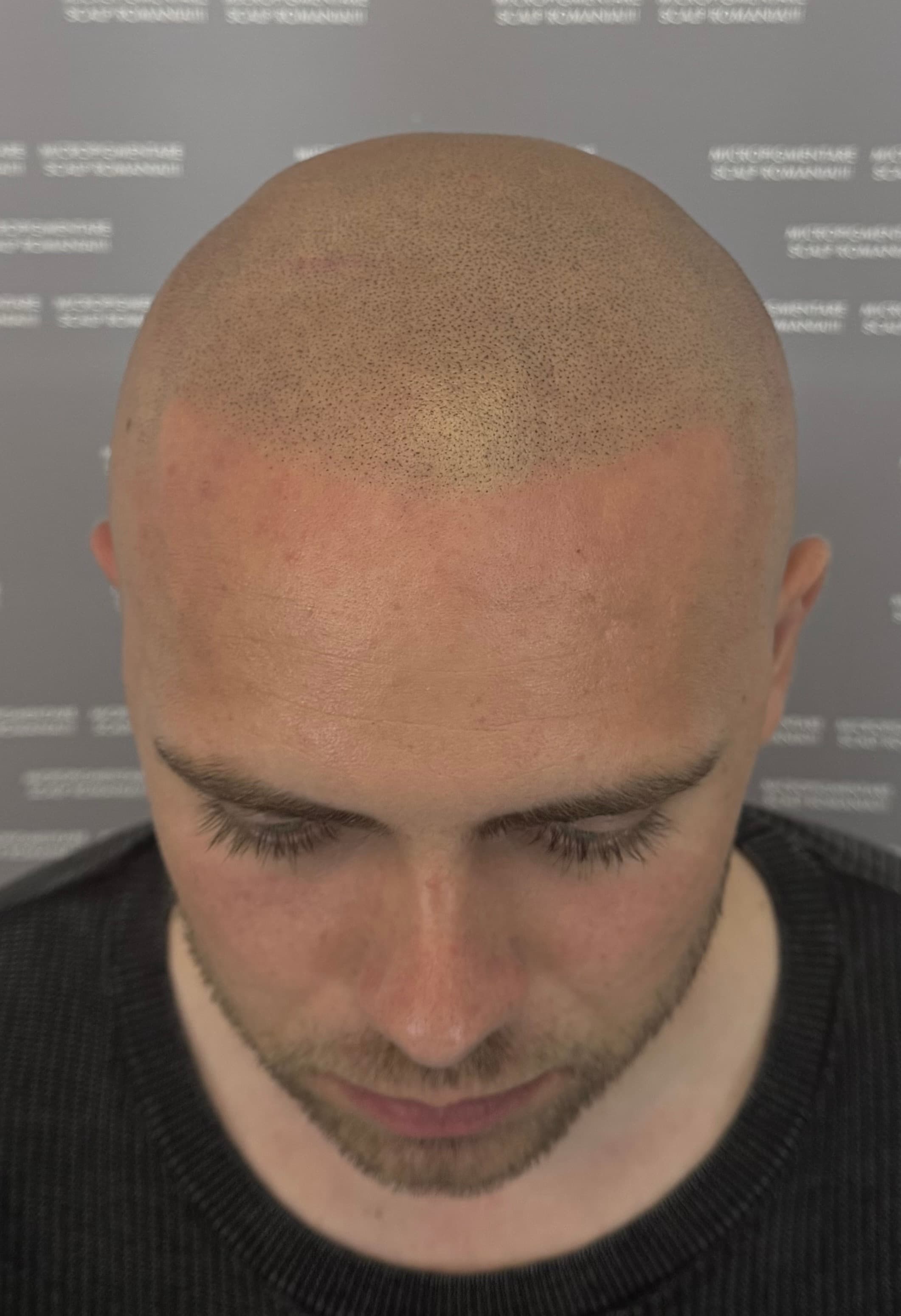 După micropigmentare scalp - Alopecie Androgenetică