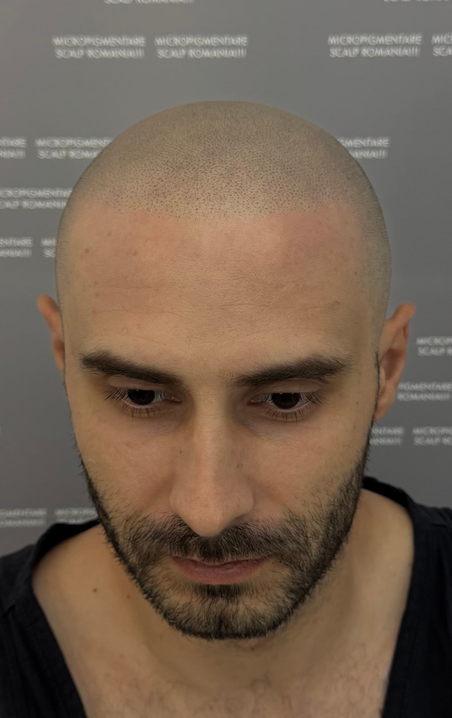 După micropigmentare scalp - Alopecie Androgenetică