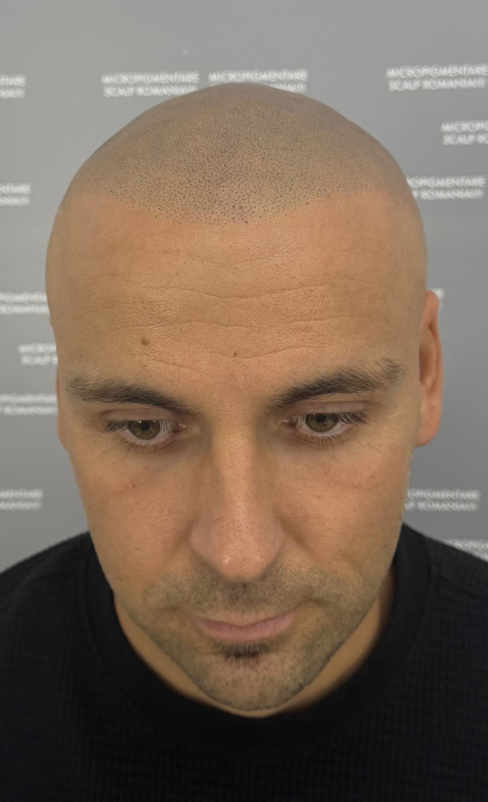 După micropigmentare scalp - Alopecie Androgenetică