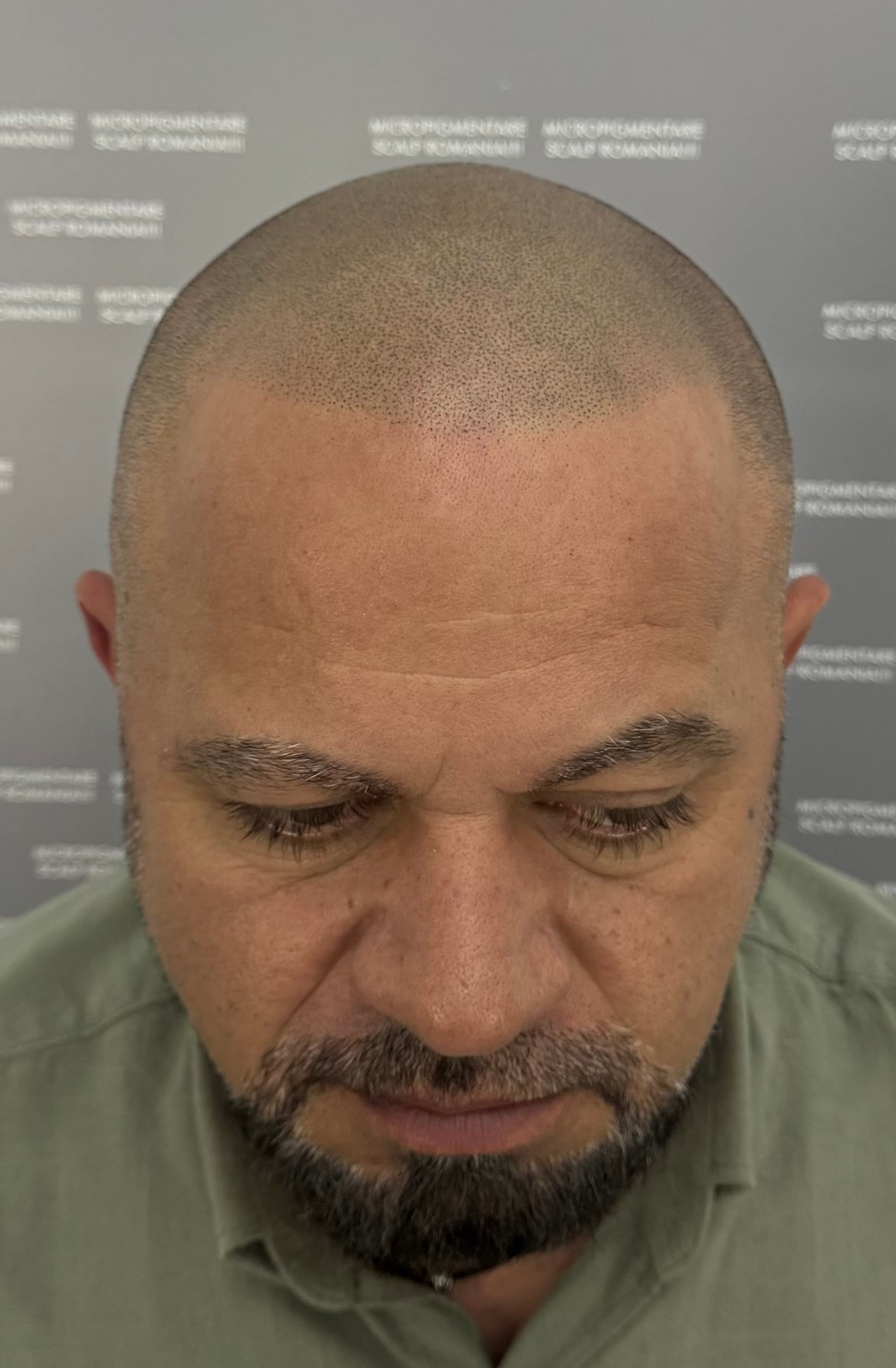 După micropigmentare scalp - Alopecie Androgenetică