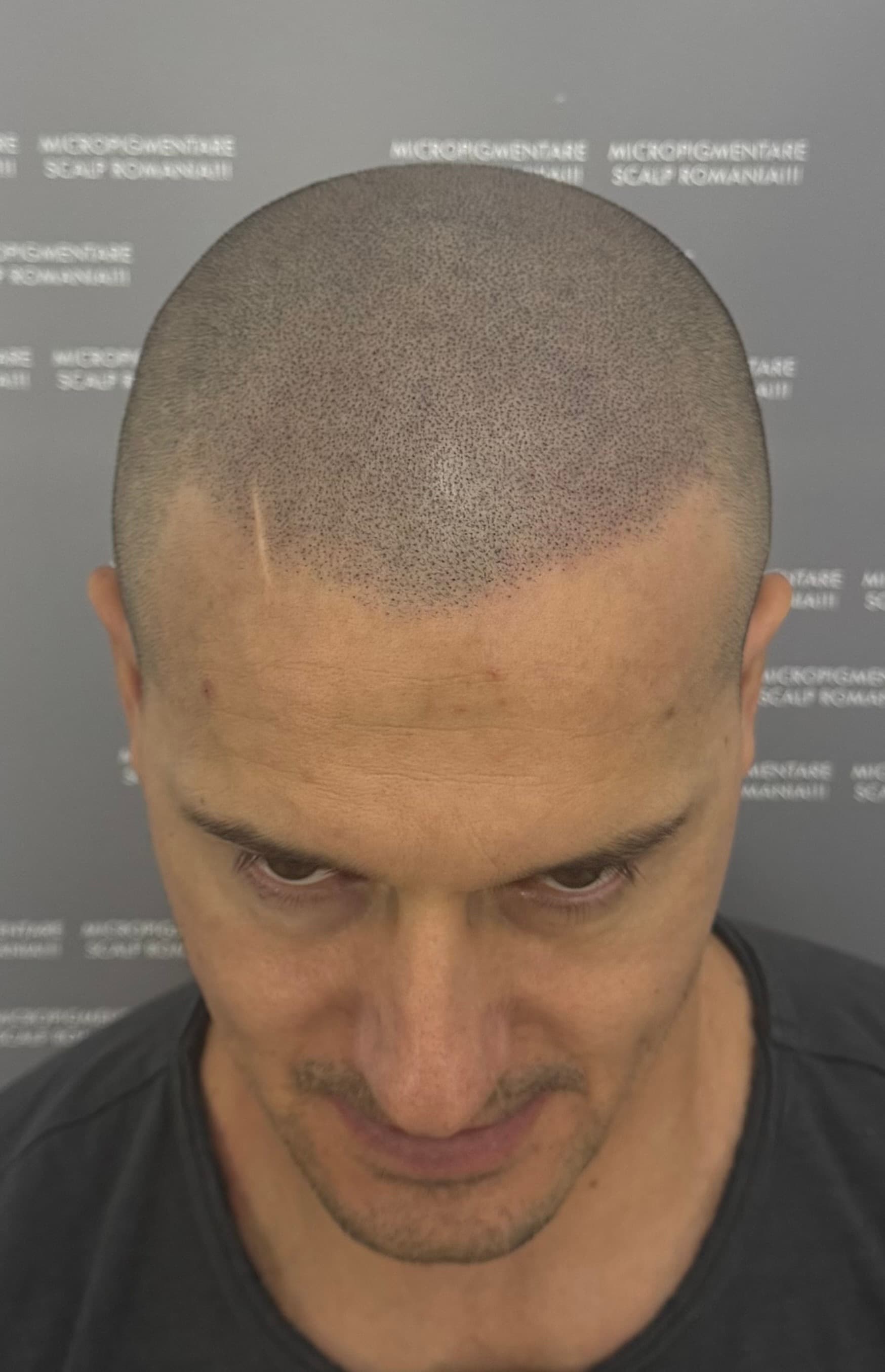 După micropigmentare scalp - Alopecie Androgenetică