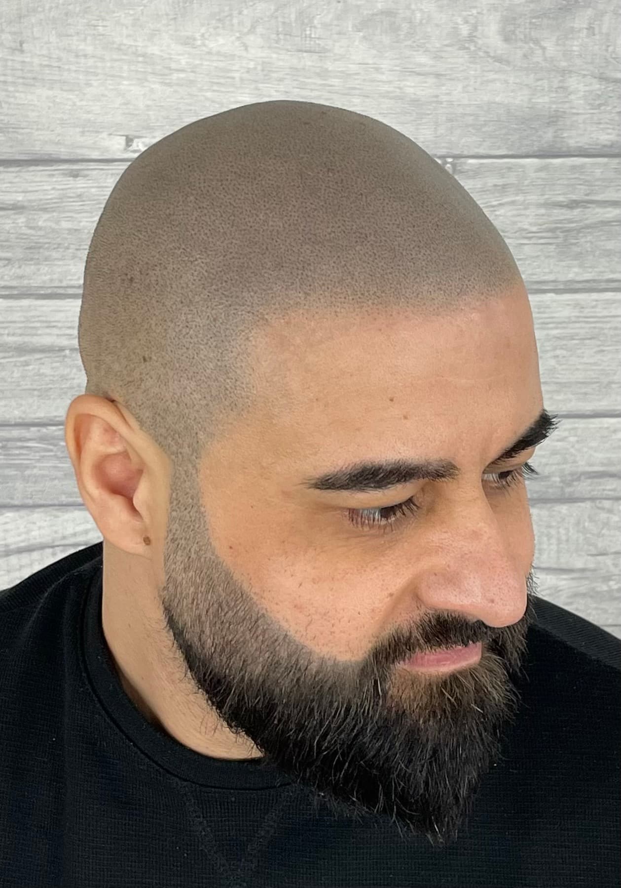 După micropigmentare scalp - Alopecie Androgenetică