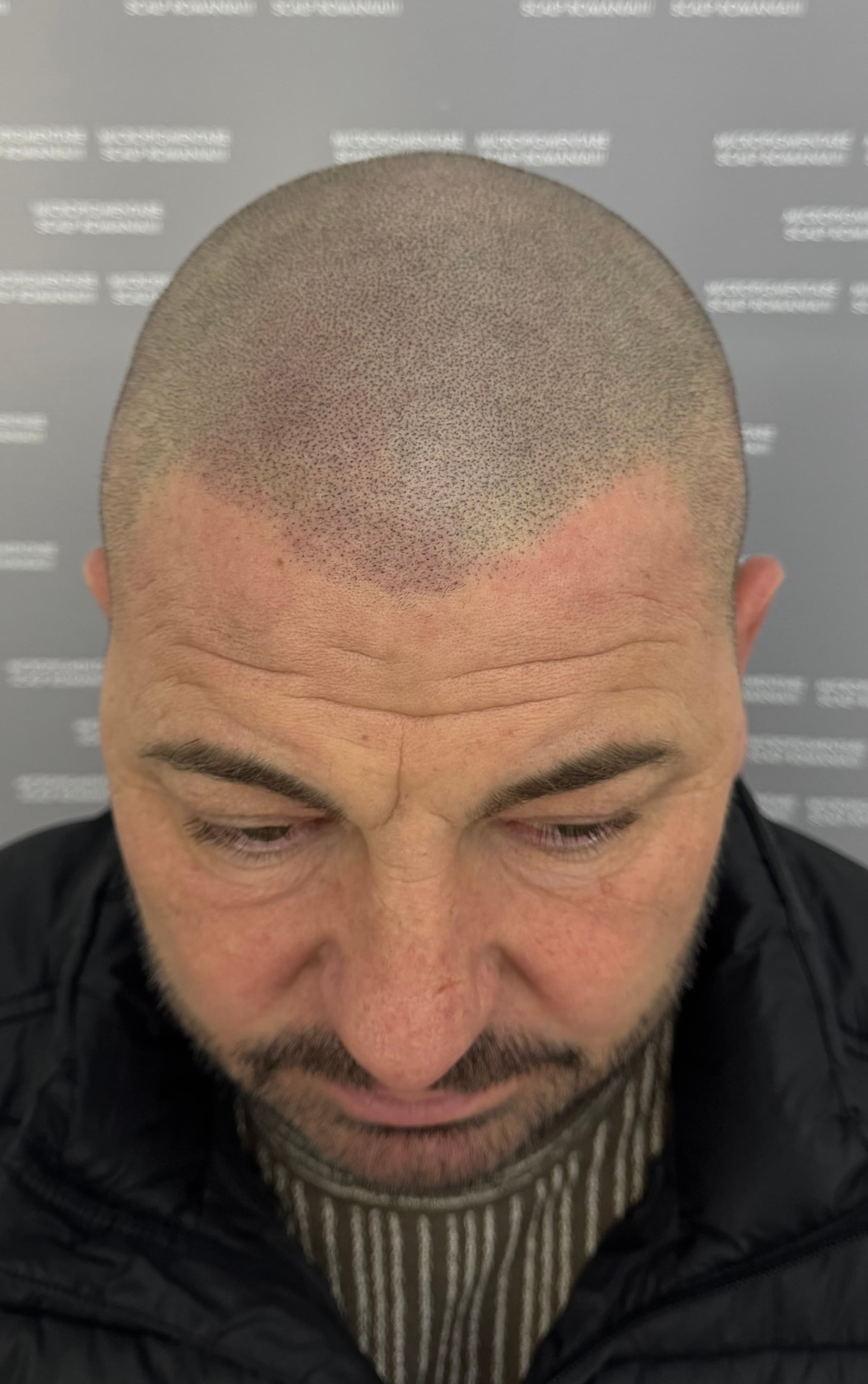 După micropigmentare scalp - Alopecie Androgenetică