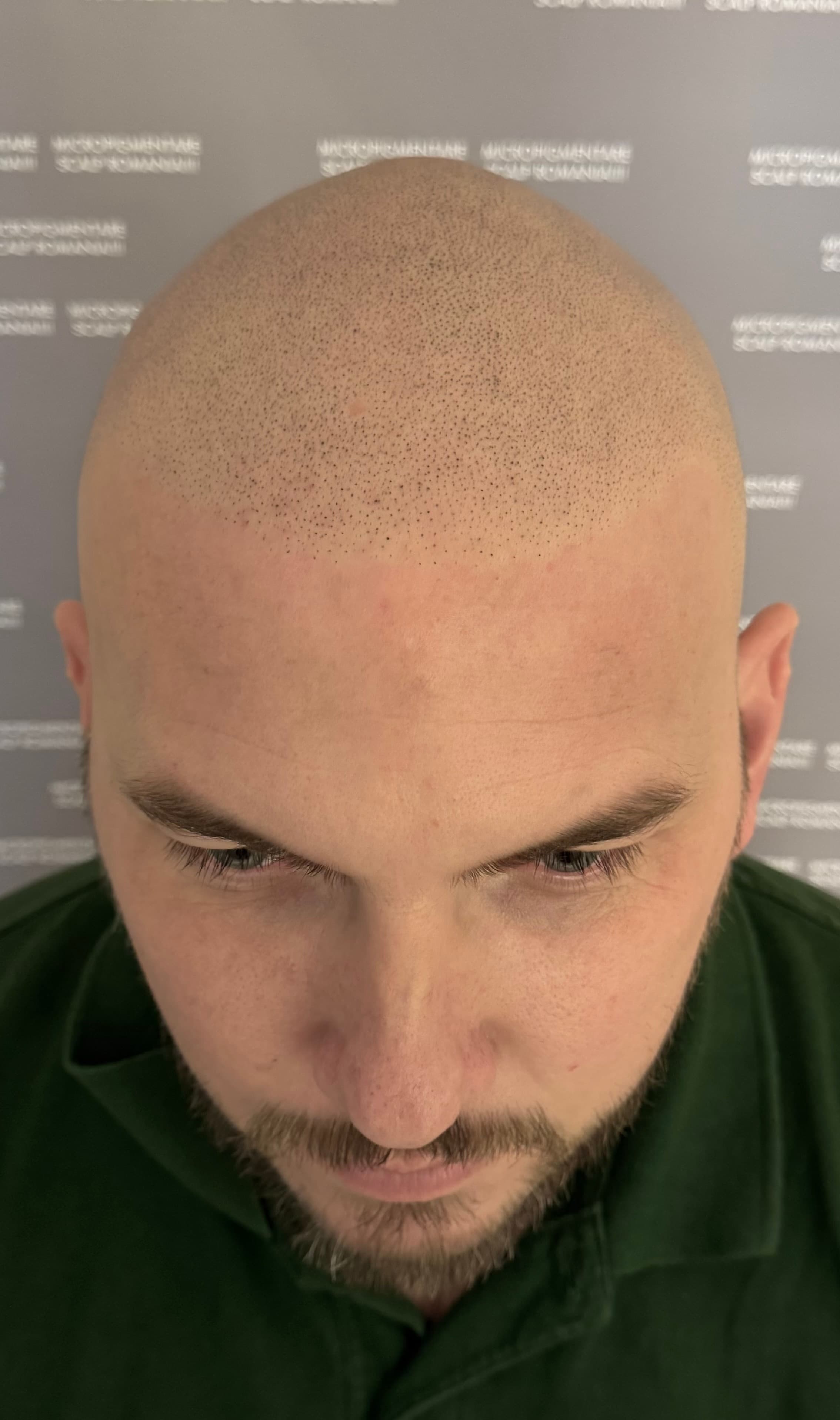După micropigmentare scalp - Alopecie Androgenetică