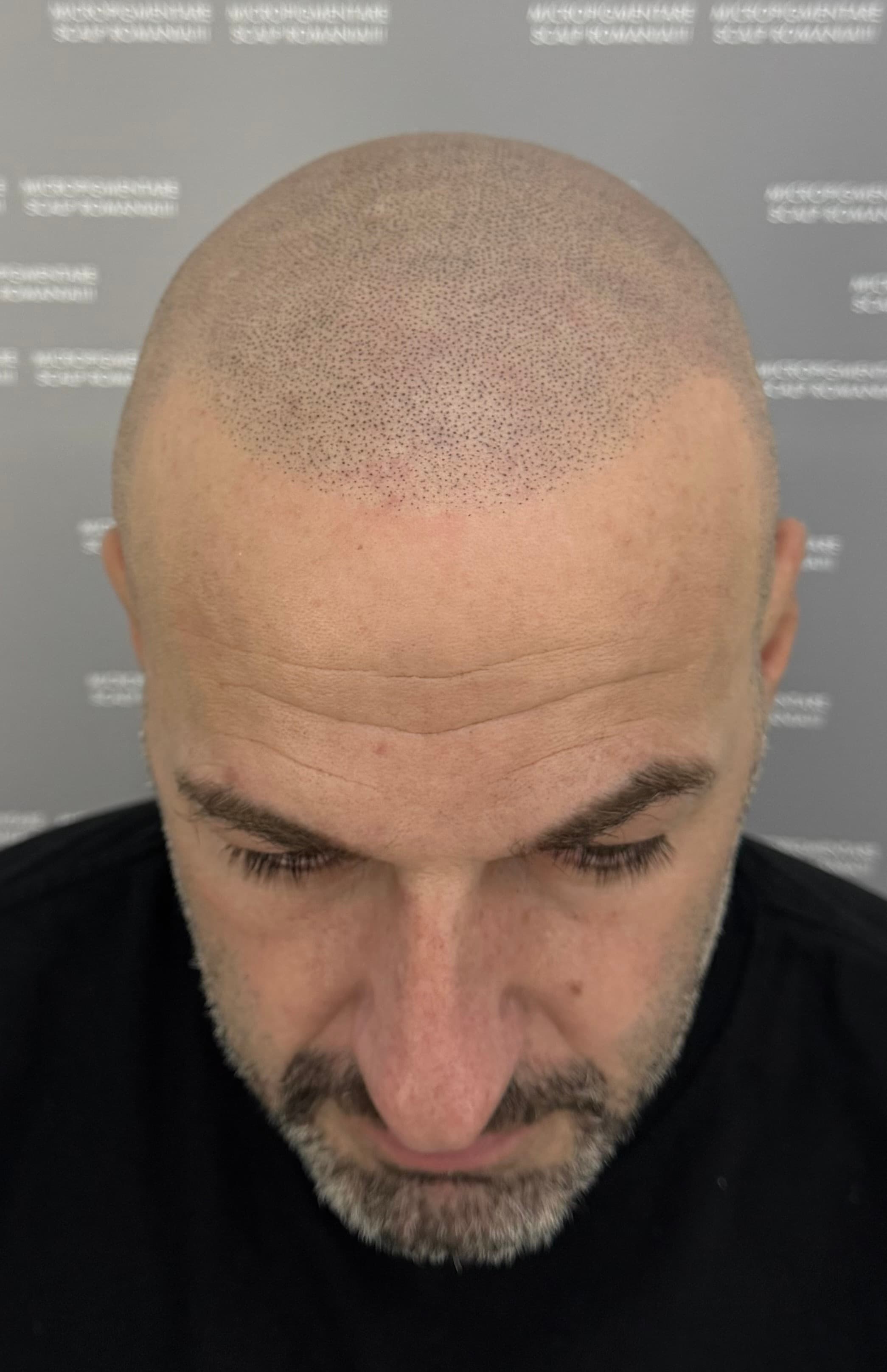 După micropigmentare scalp - Alopecie Androgenetică