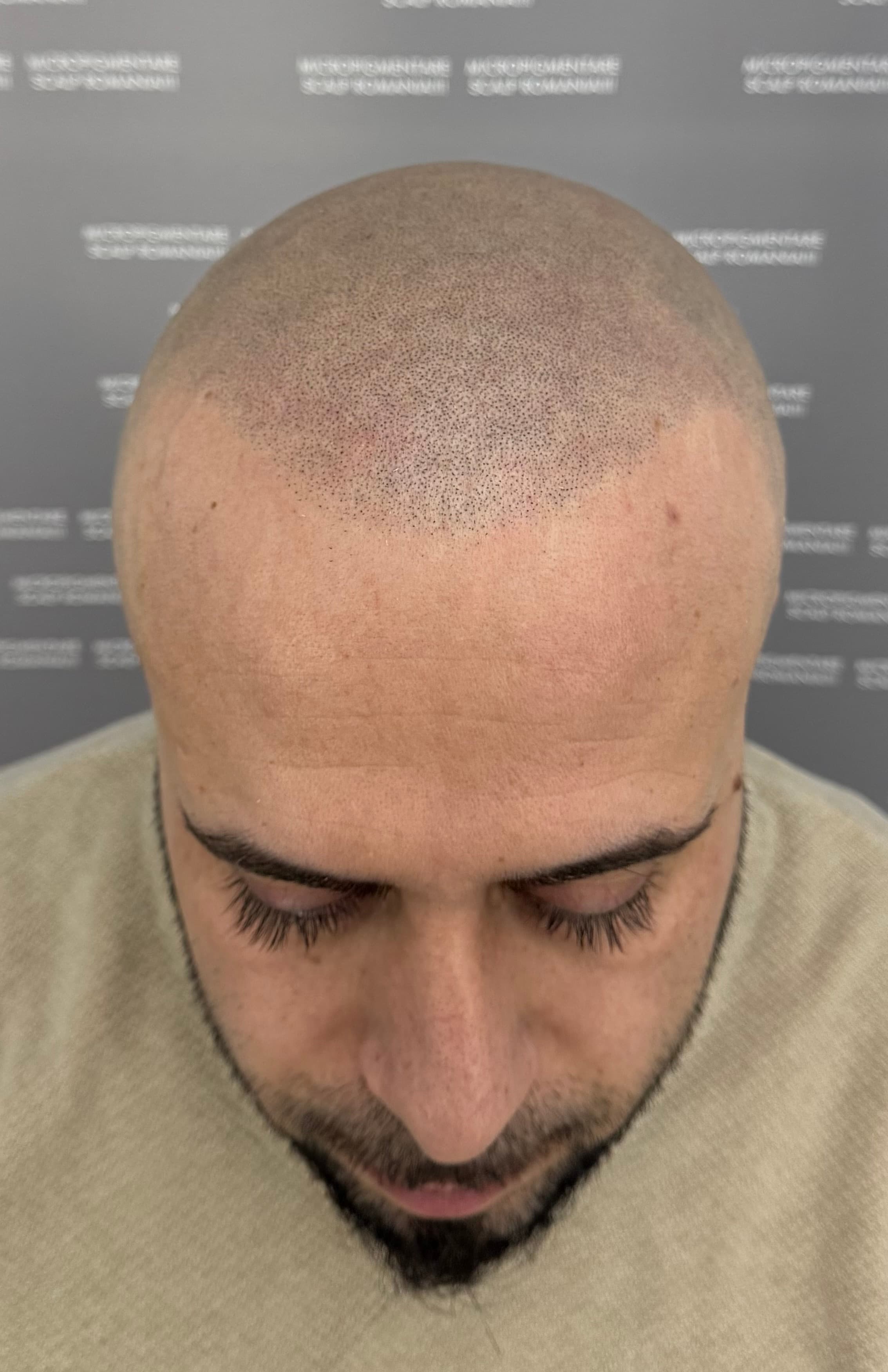 După micropigmentare scalp - Alopecie Androgenetică