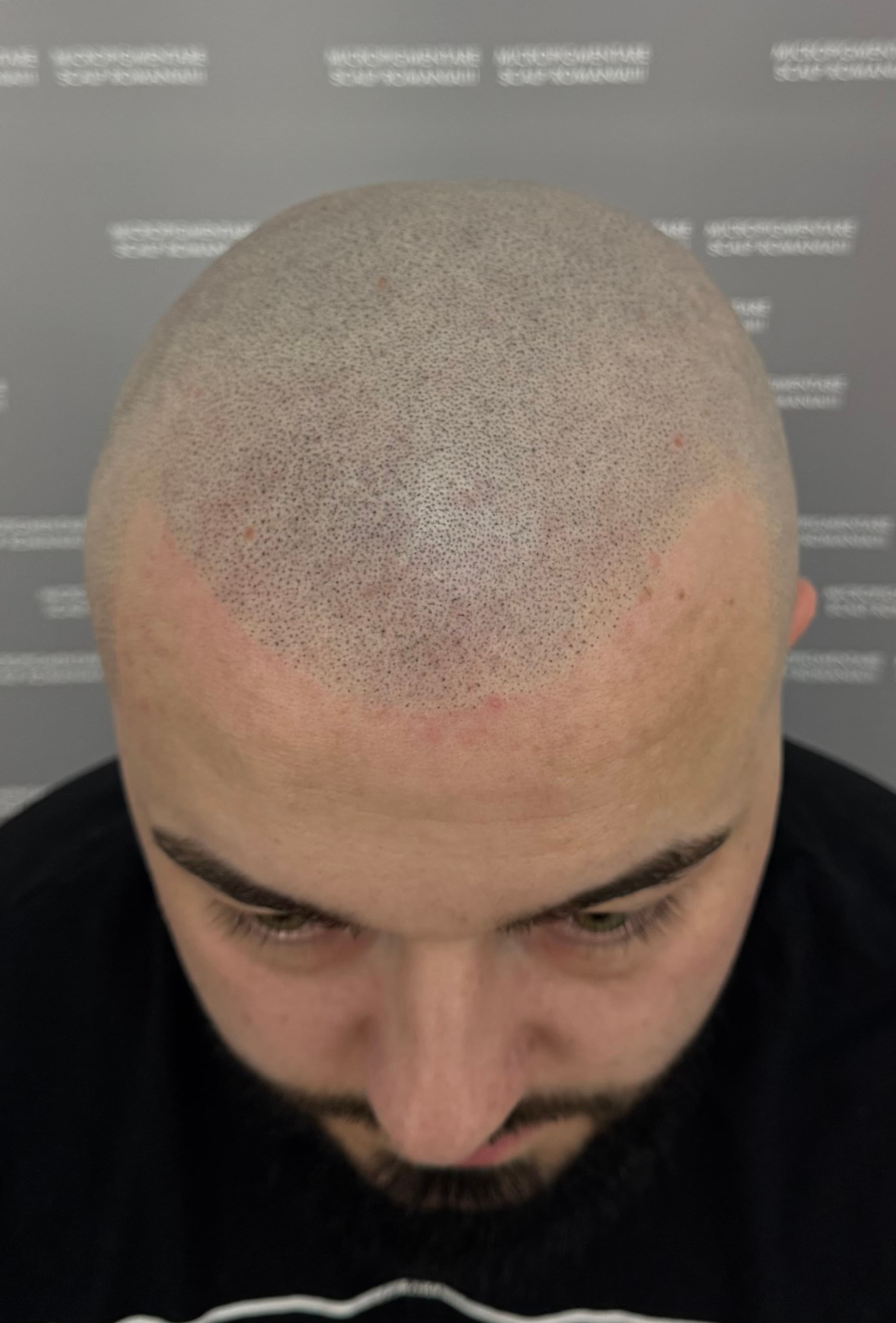 După micropigmentare scalp - Alopecie Androgenetică