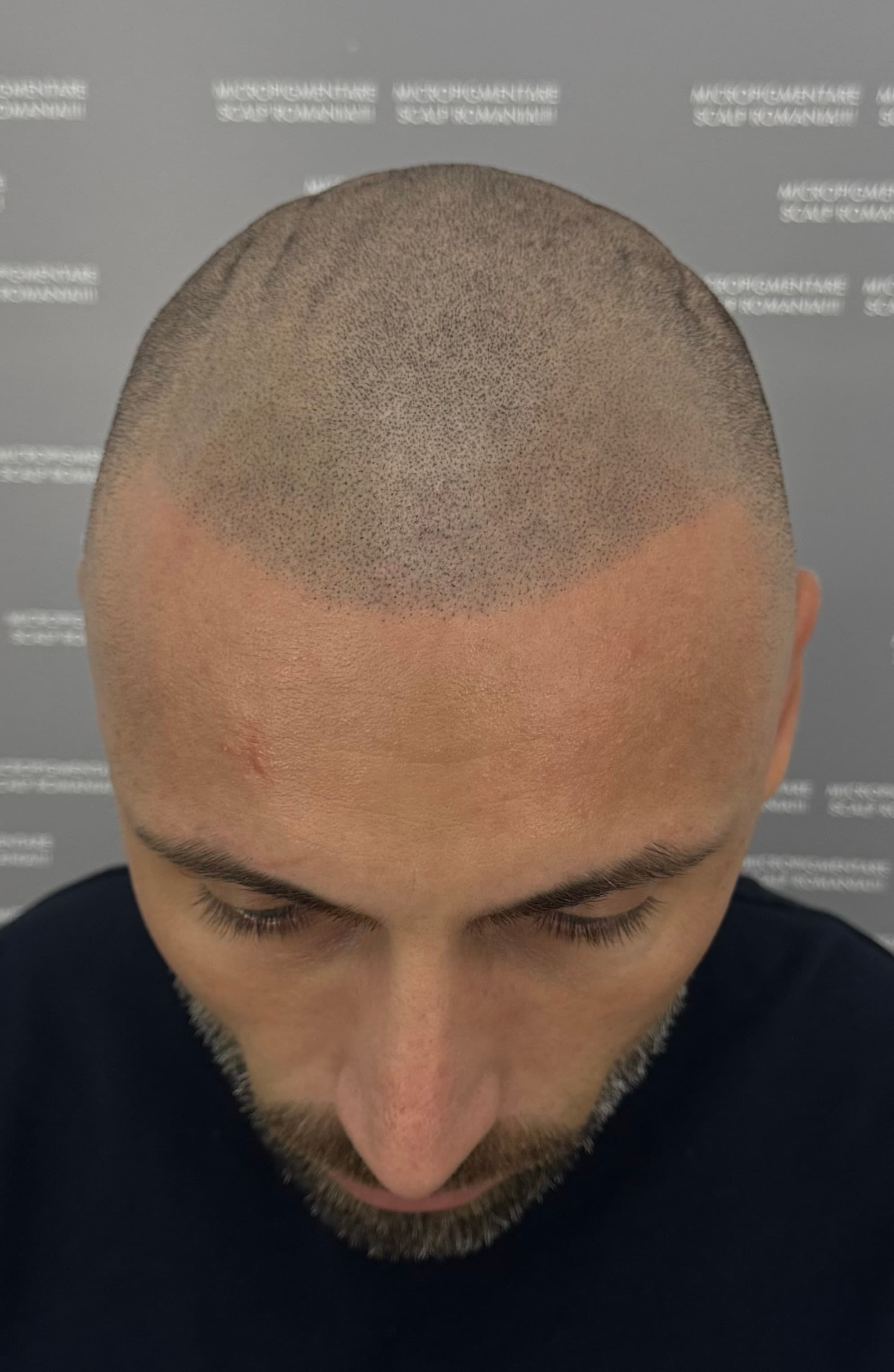 După micropigmentare scalp - Alopecie Androgenetică