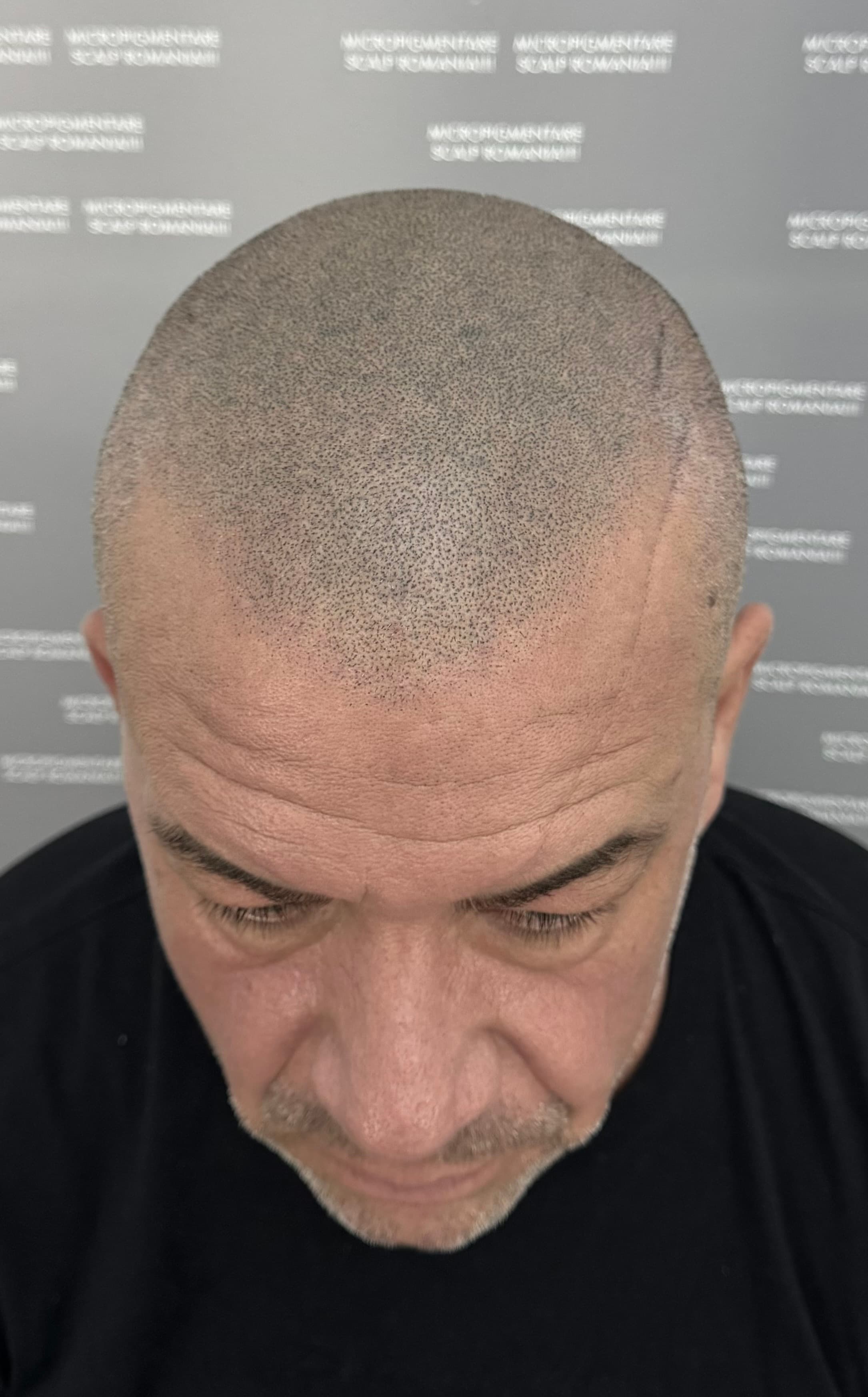 După micropigmentare scalp - Alopecie Androgenetică