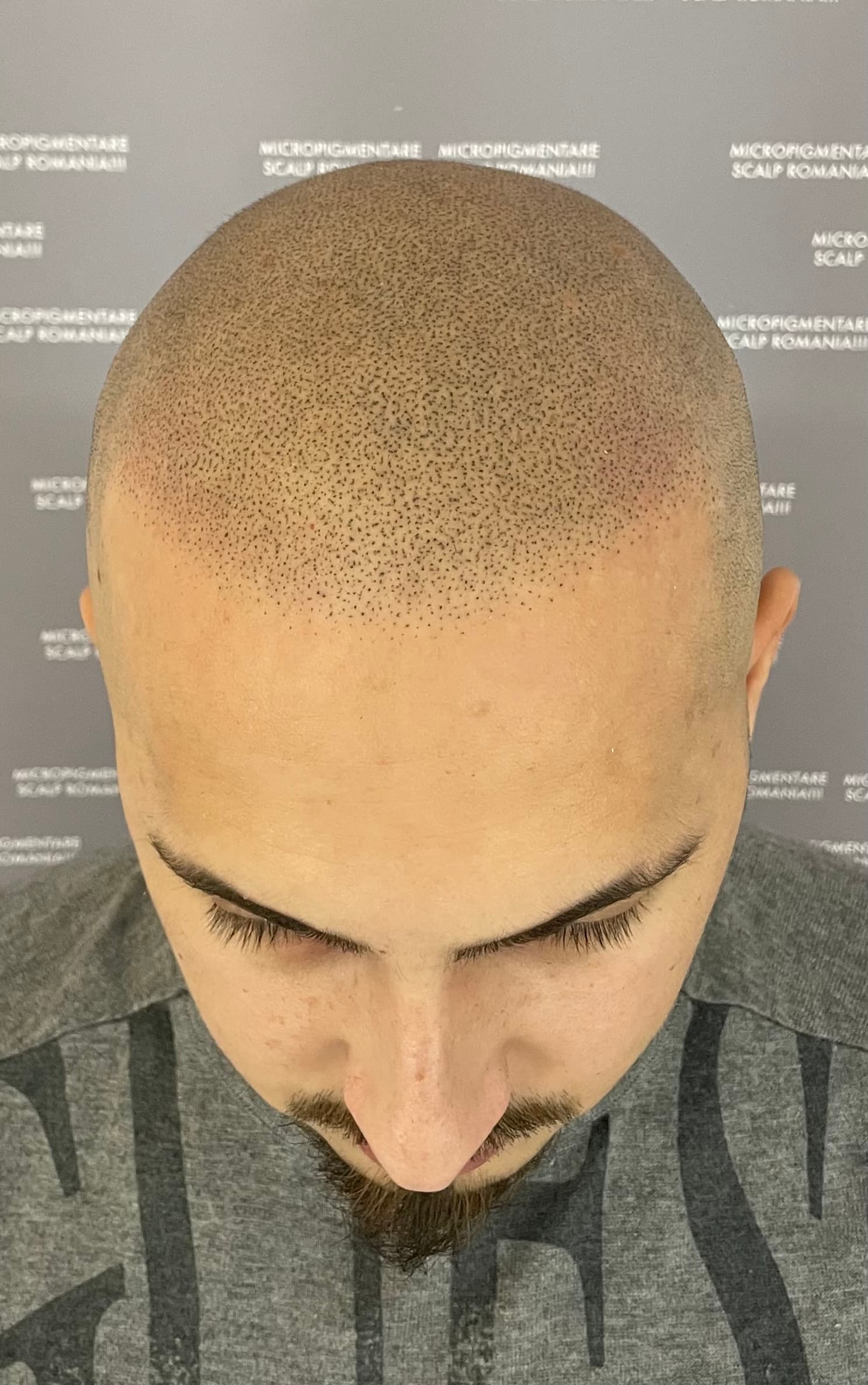 După micropigmentare scalp - Alopecie Androgenetică