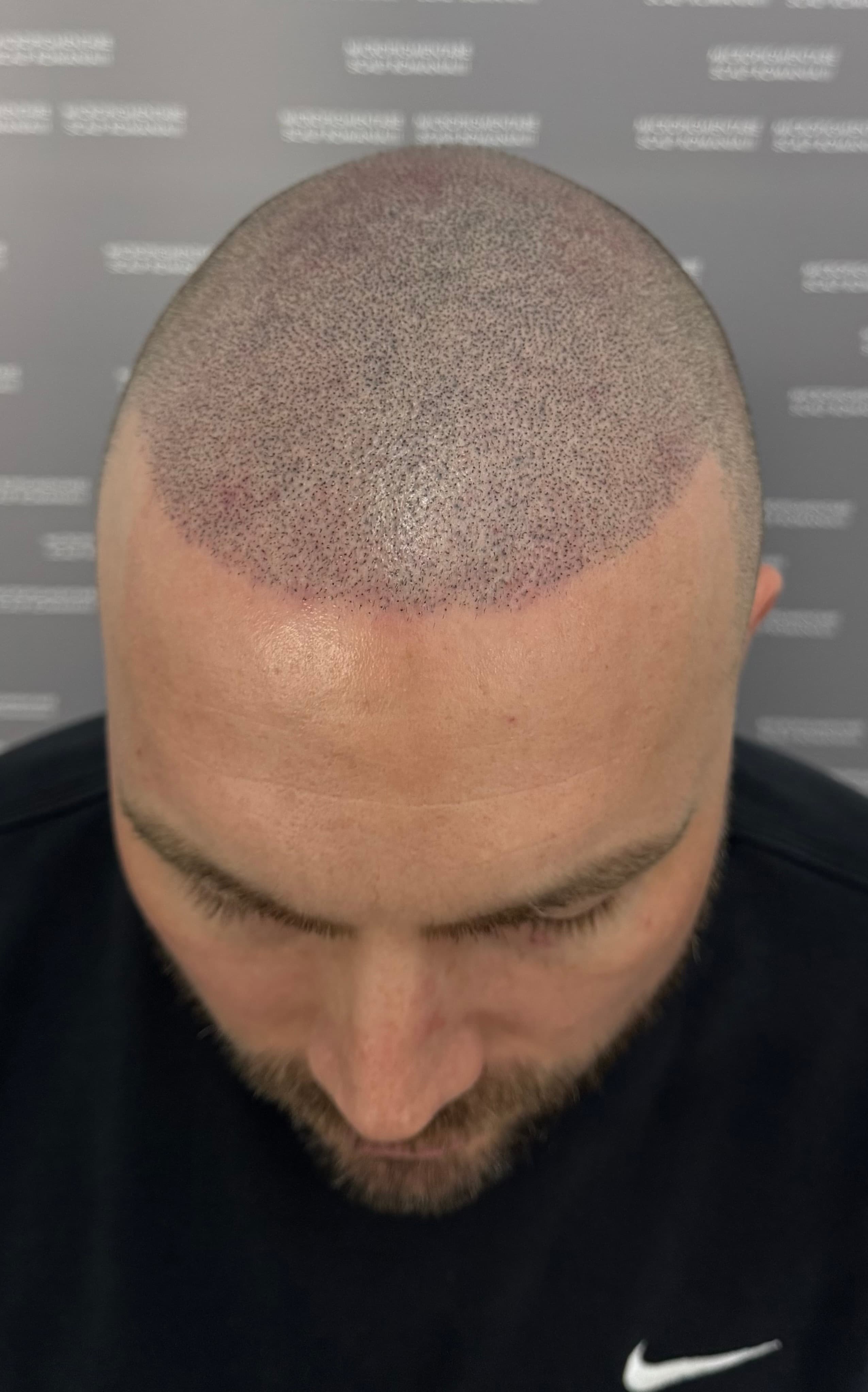 După micropigmentare scalp - Densitate Post Transplant