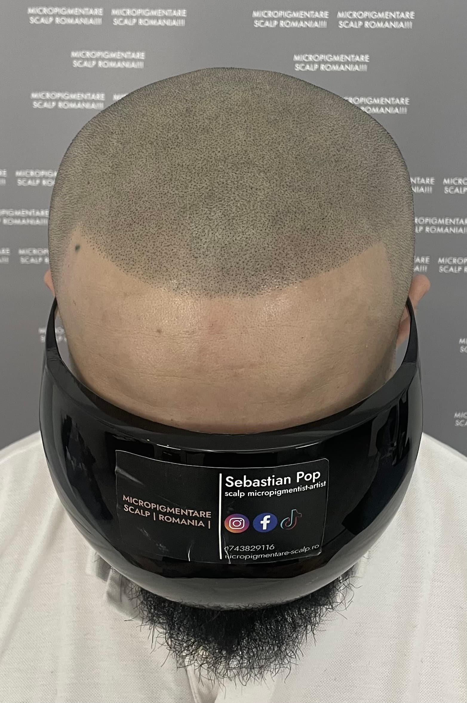 După micropigmentare scalp - Alopecie Androgenetică