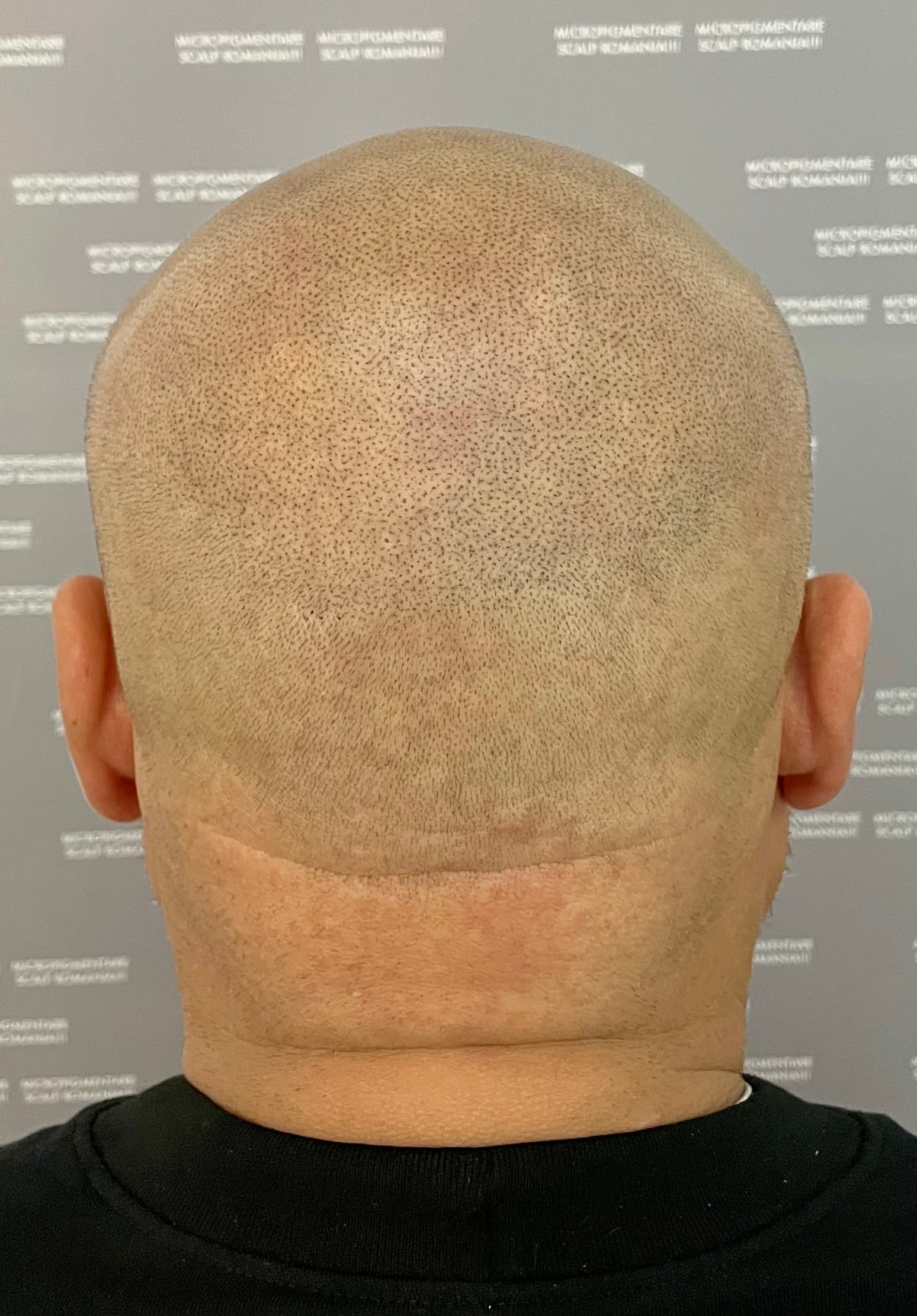 După micropigmentare scalp - Alopecie Androgenetică