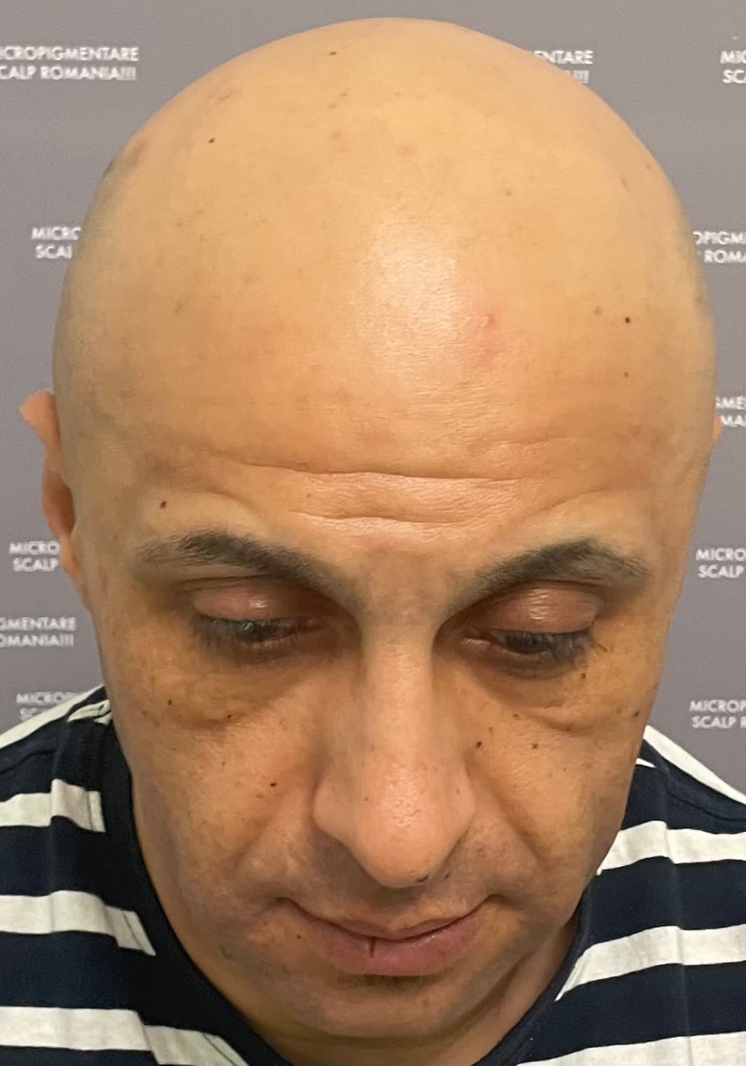 Înainte de micropigmentare scalp - Alopecie Androgenetică