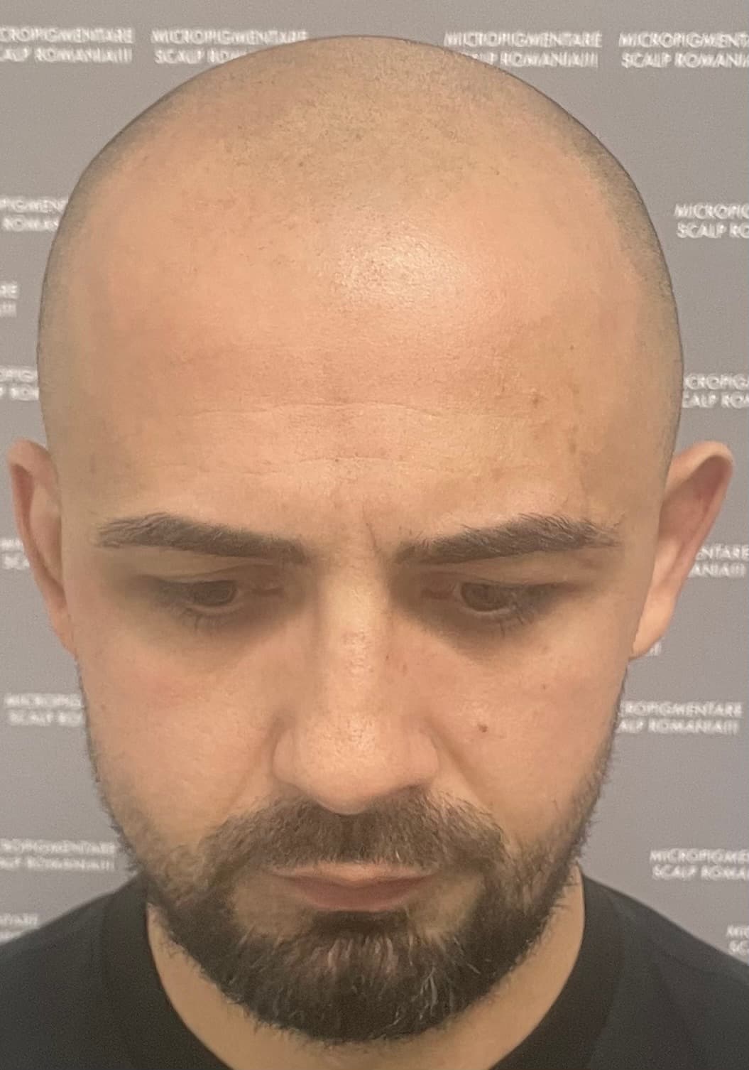 Înainte de micropigmentare scalp - Alopecie Androgenetică