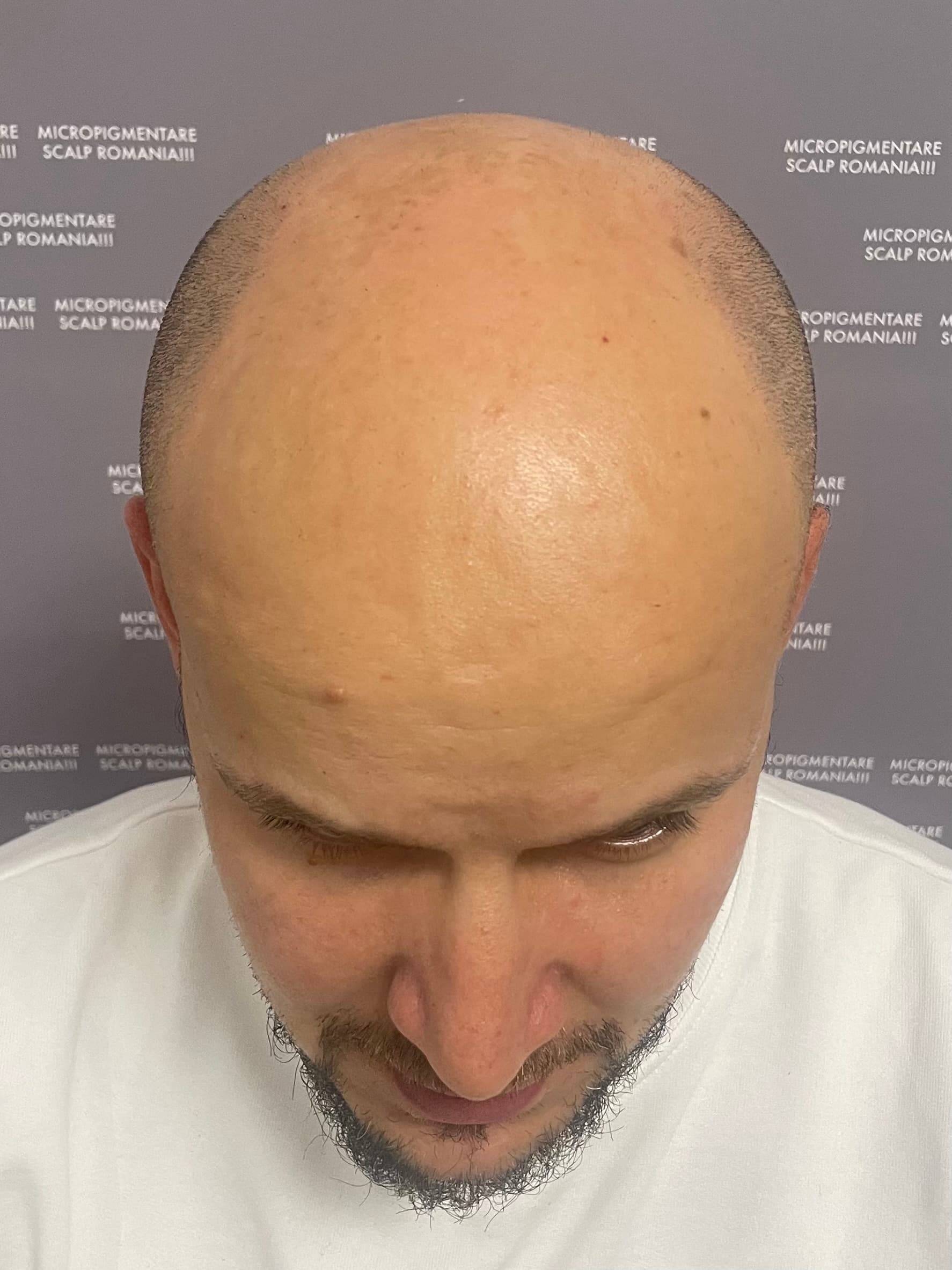 Înainte de micropigmentare scalp - Alopecie Androgenetică