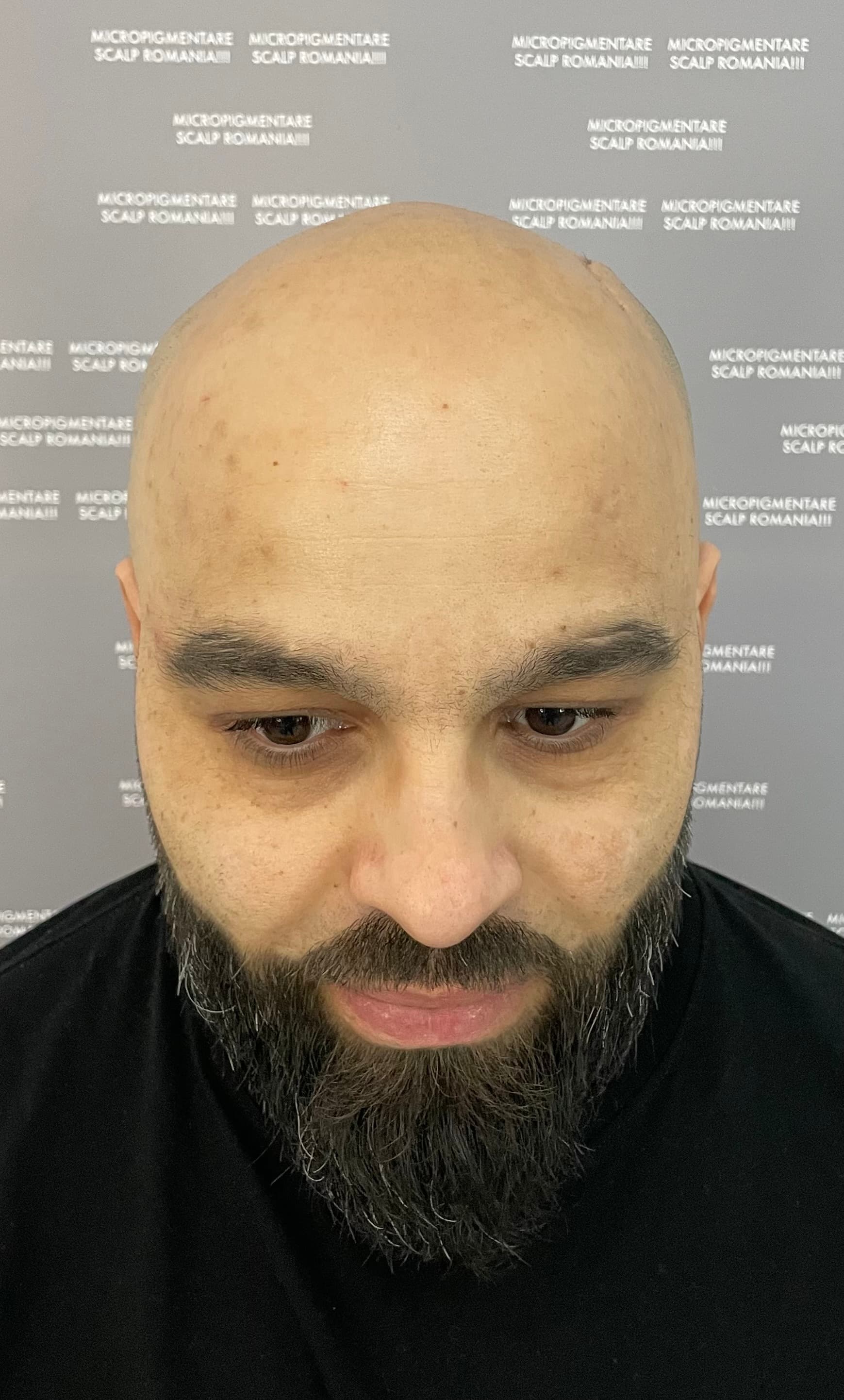Înainte de micropigmentare scalp - Alopecie Androgenetică