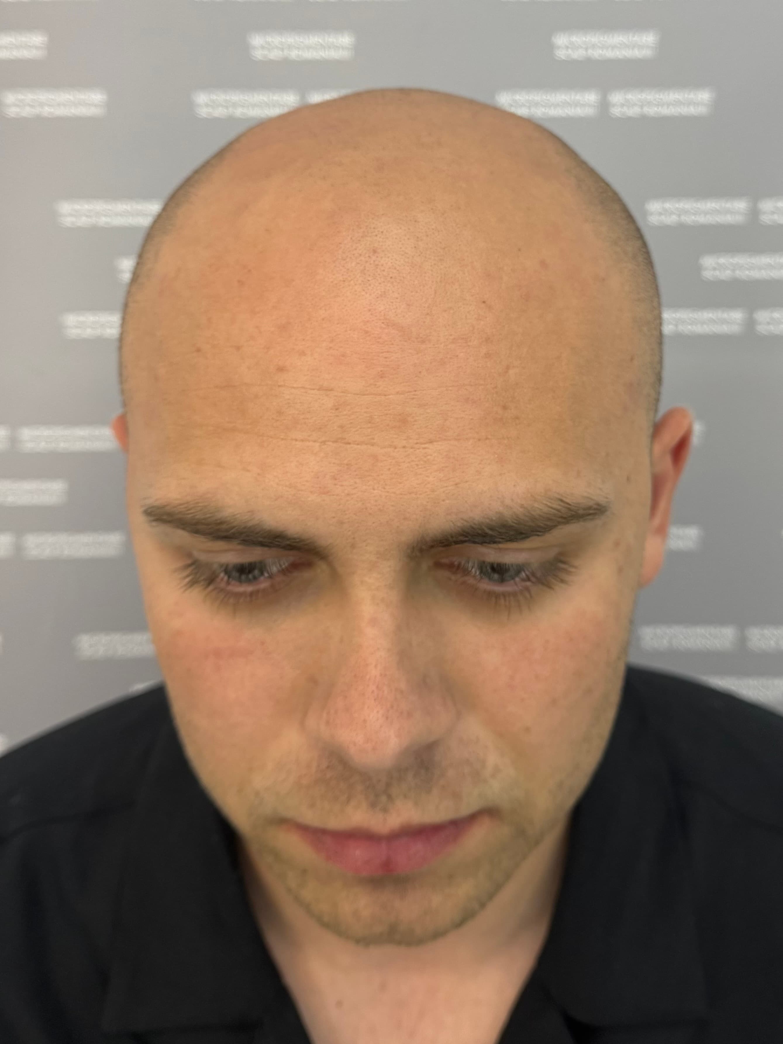 Înainte de micropigmentare scalp - Alopecie Androgenetică