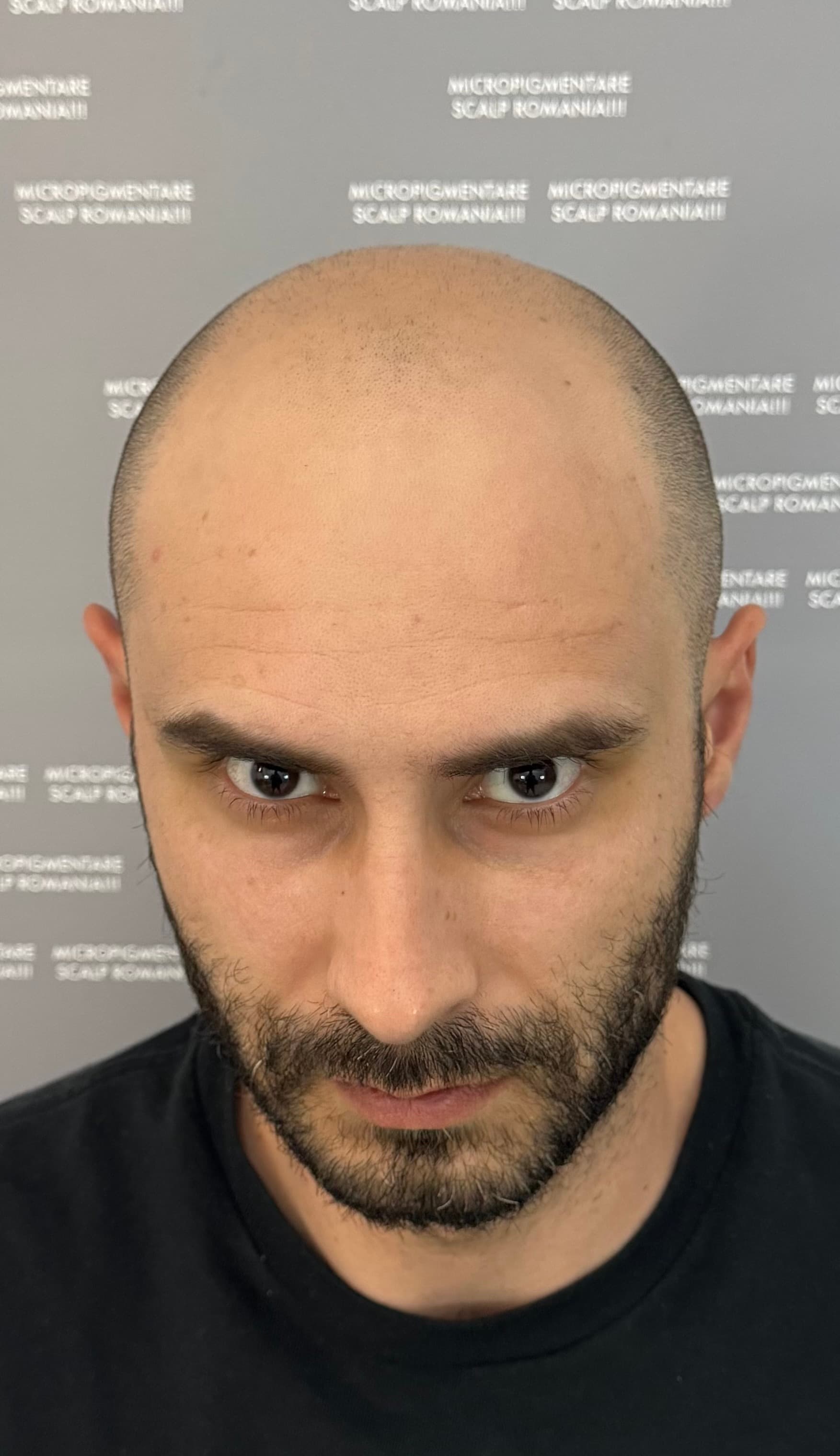 Înainte de micropigmentare scalp - Alopecie Androgenetică