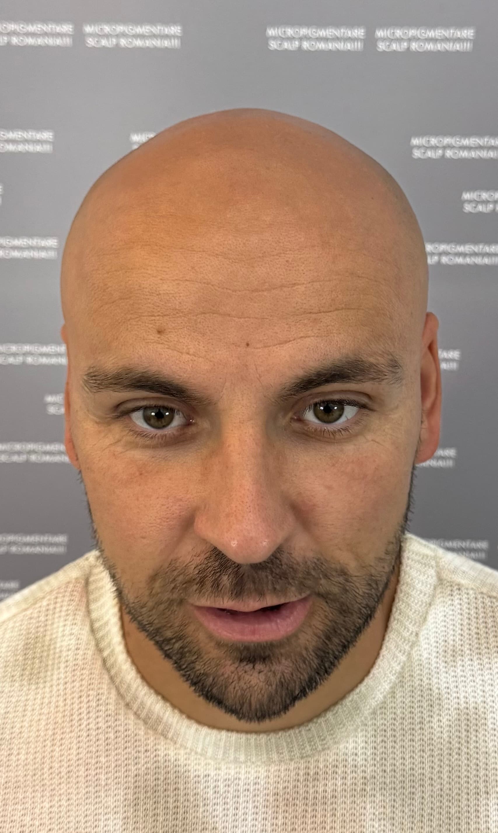 Înainte de micropigmentare scalp - Alopecie Androgenetică