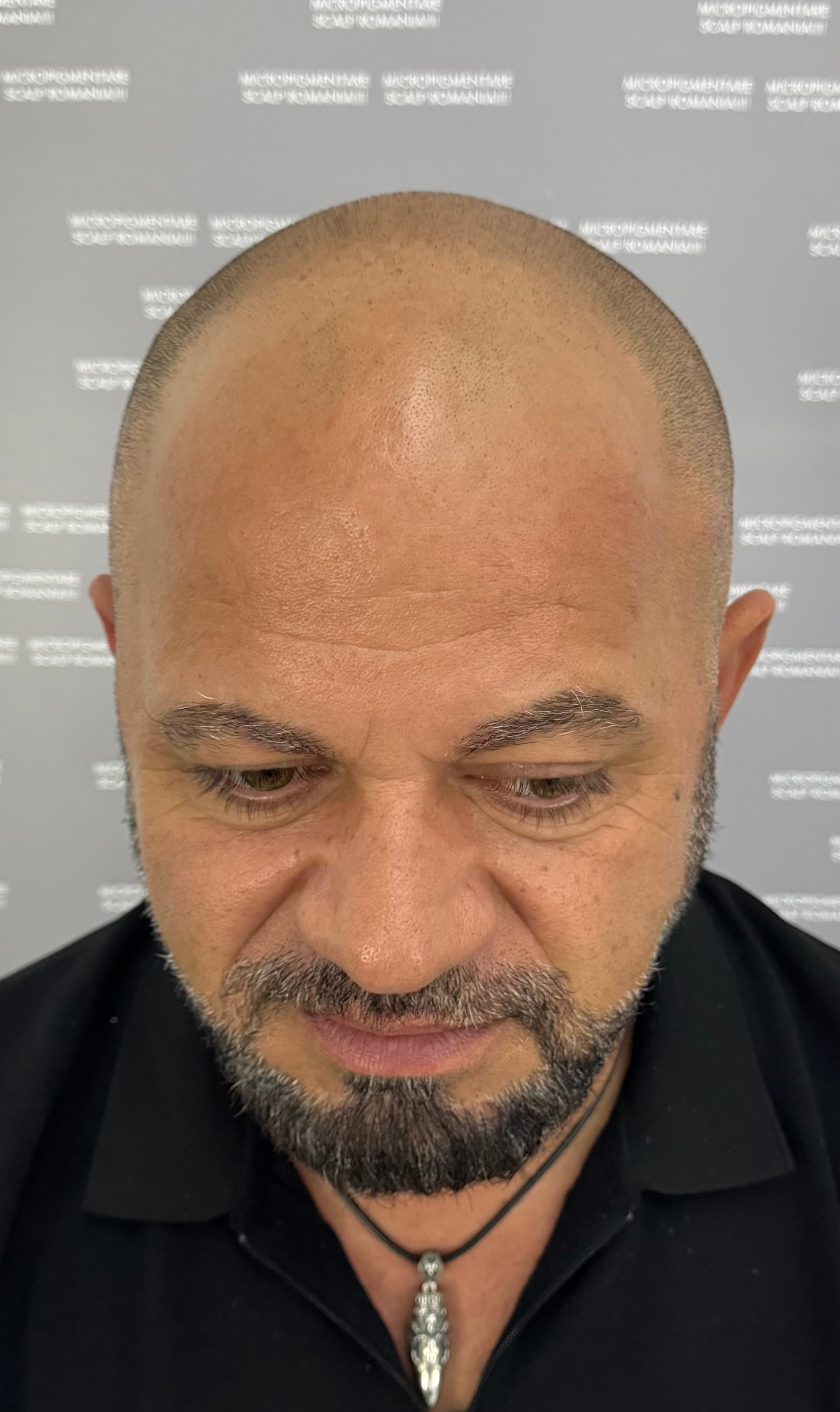 Înainte de micropigmentare scalp - Alopecie Androgenetică