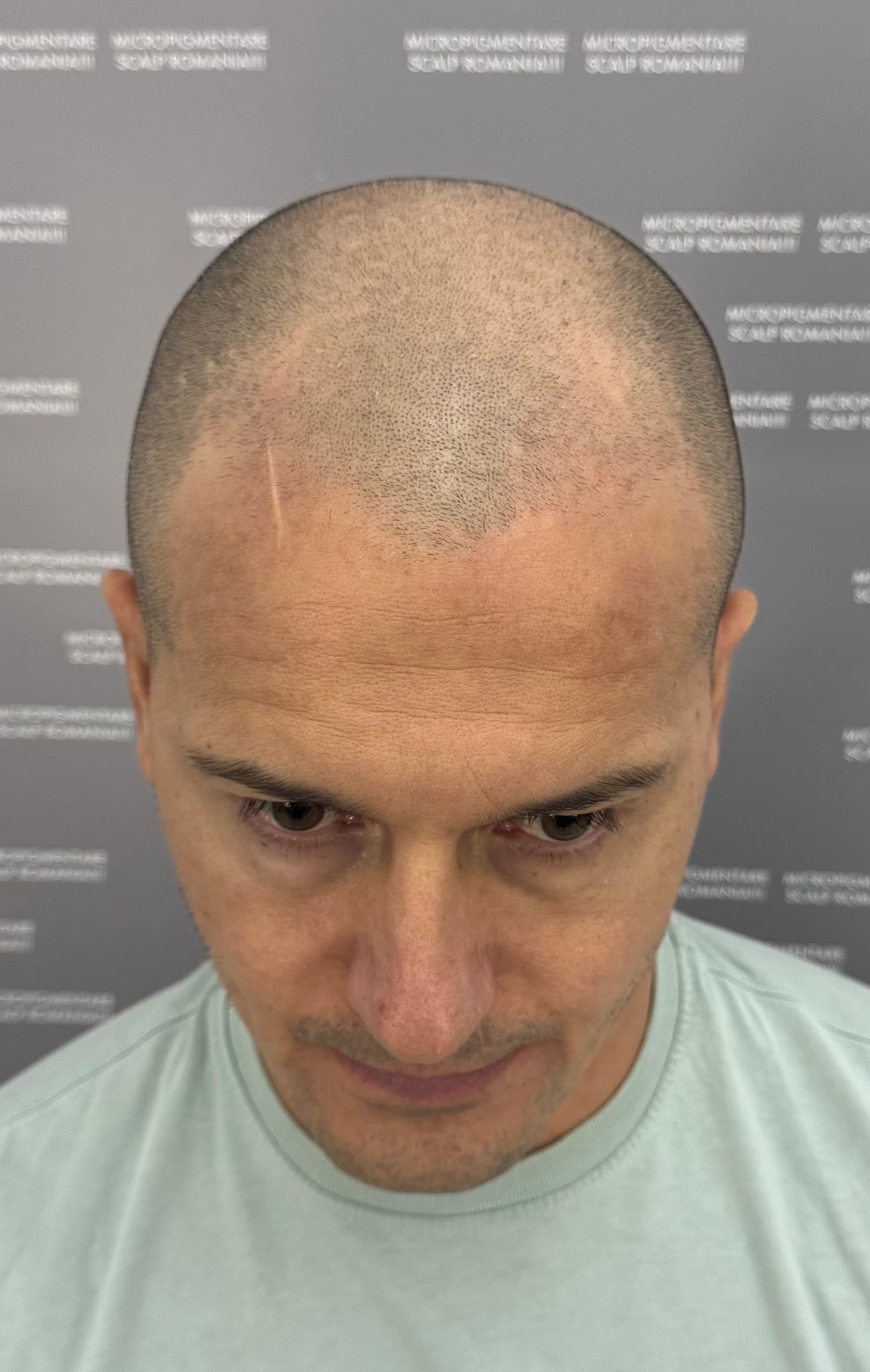 Înainte de micropigmentare scalp - Alopecie Androgenetică