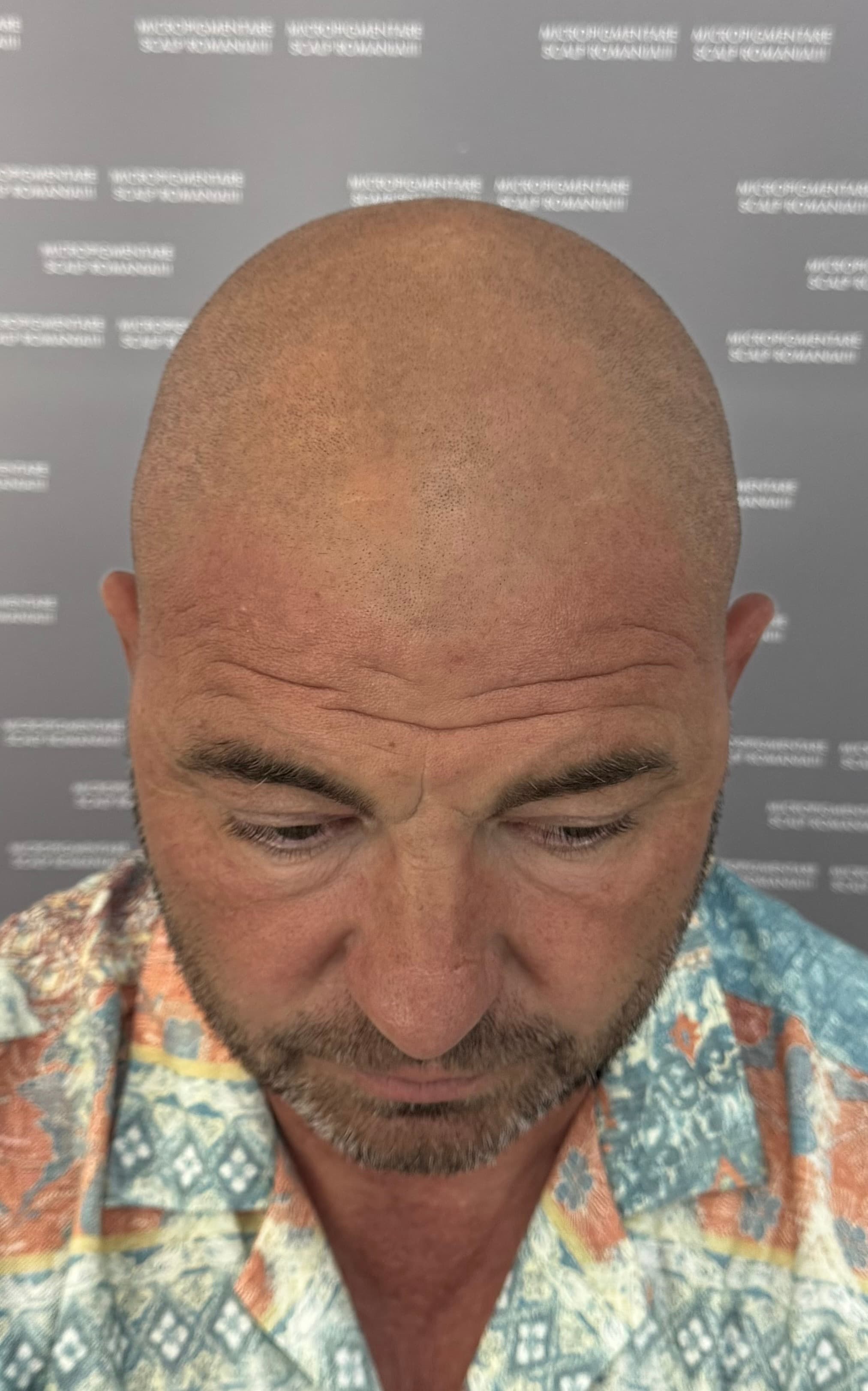 Înainte de micropigmentare scalp - Alopecie Androgenetică