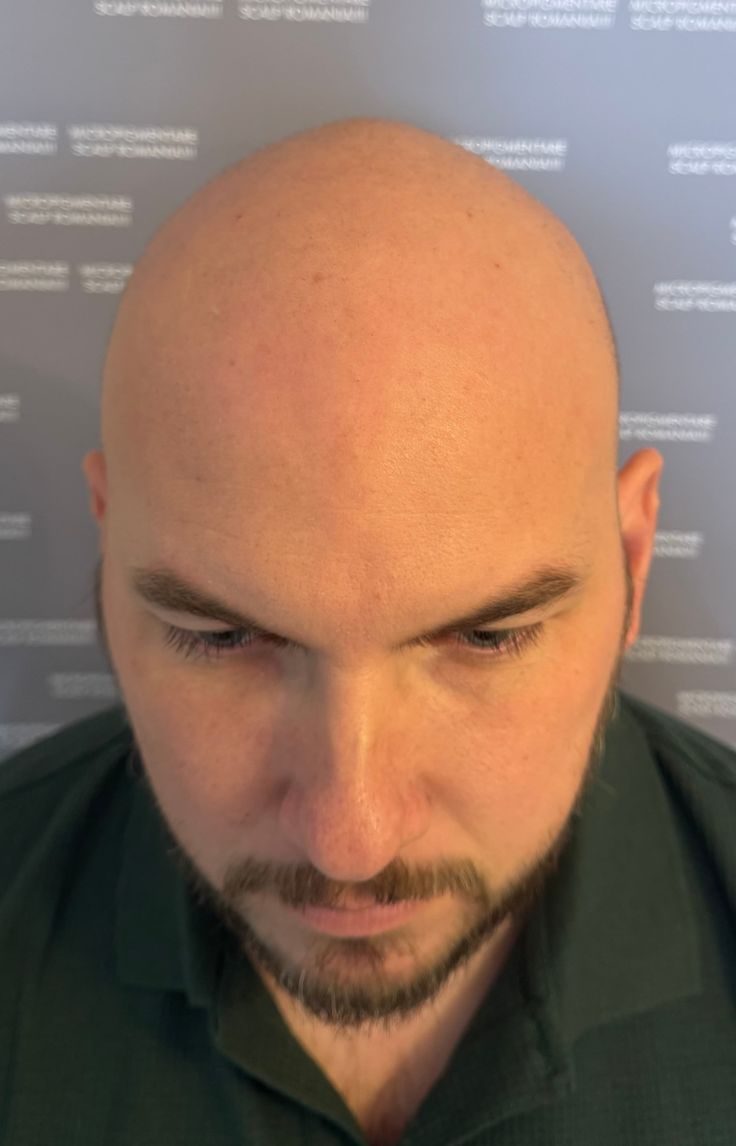 Înainte de micropigmentare scalp - Alopecie Androgenetică