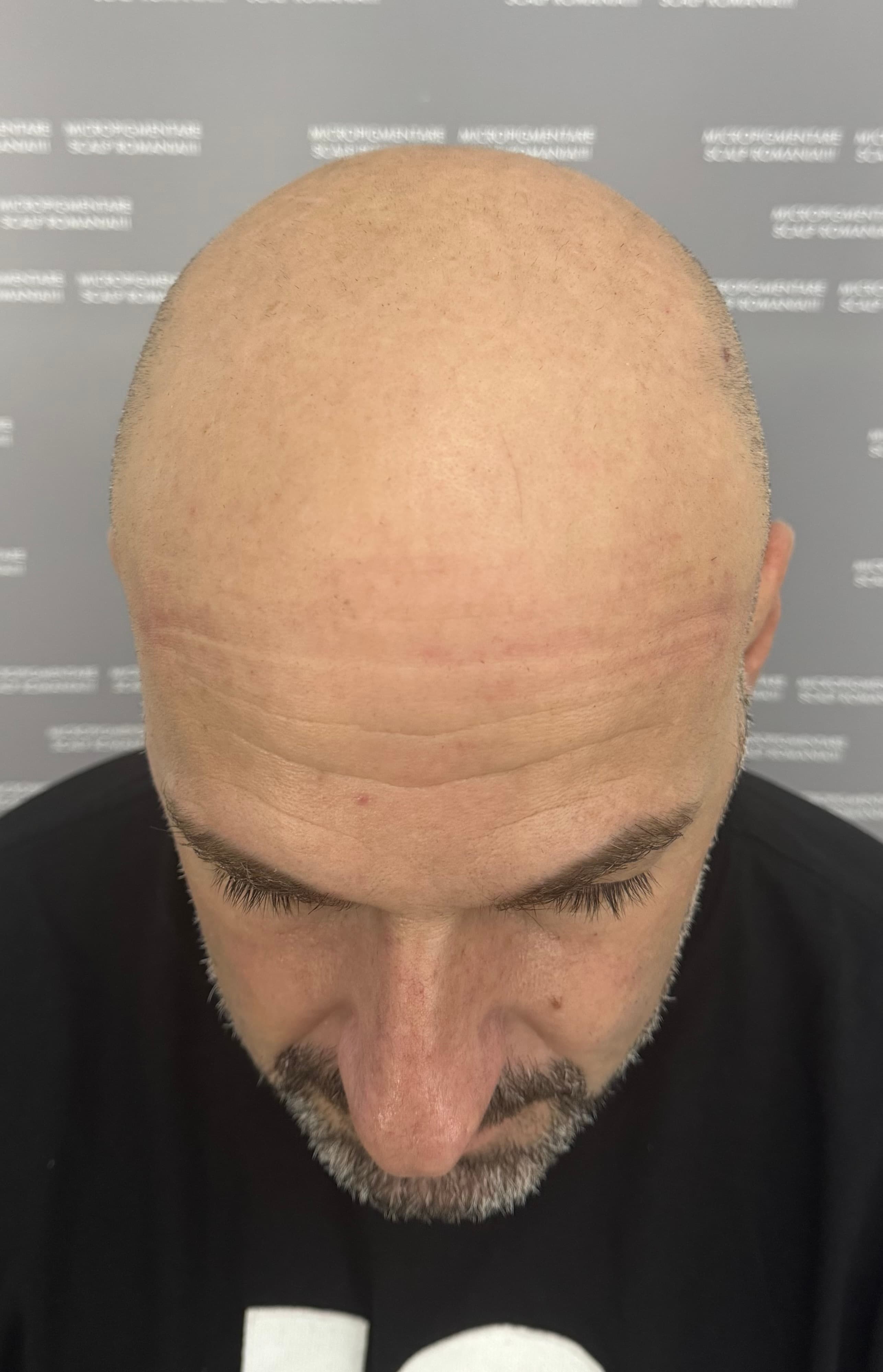 Înainte de micropigmentare scalp - Alopecie Androgenetică