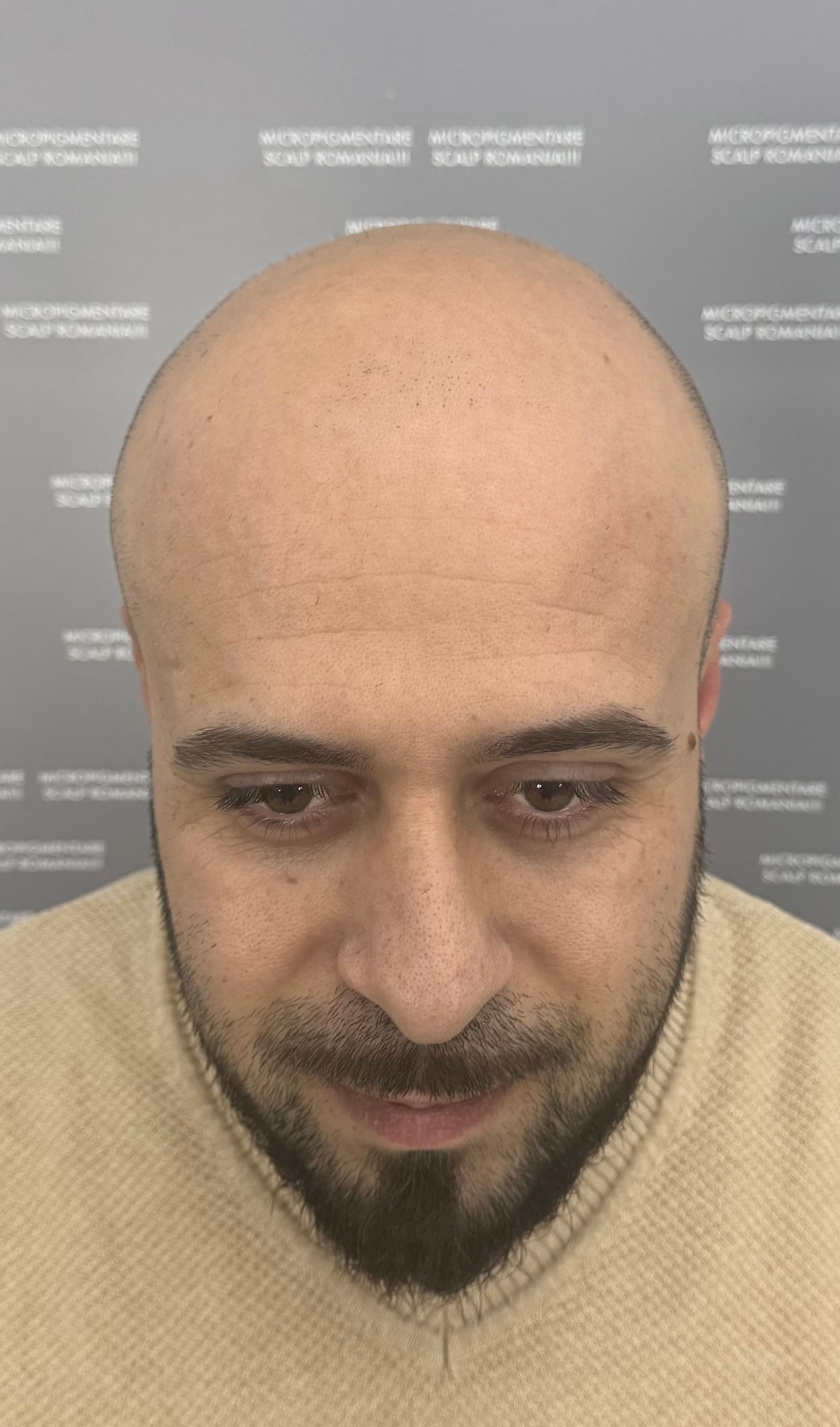 Înainte de micropigmentare scalp - Alopecie Androgenetică
