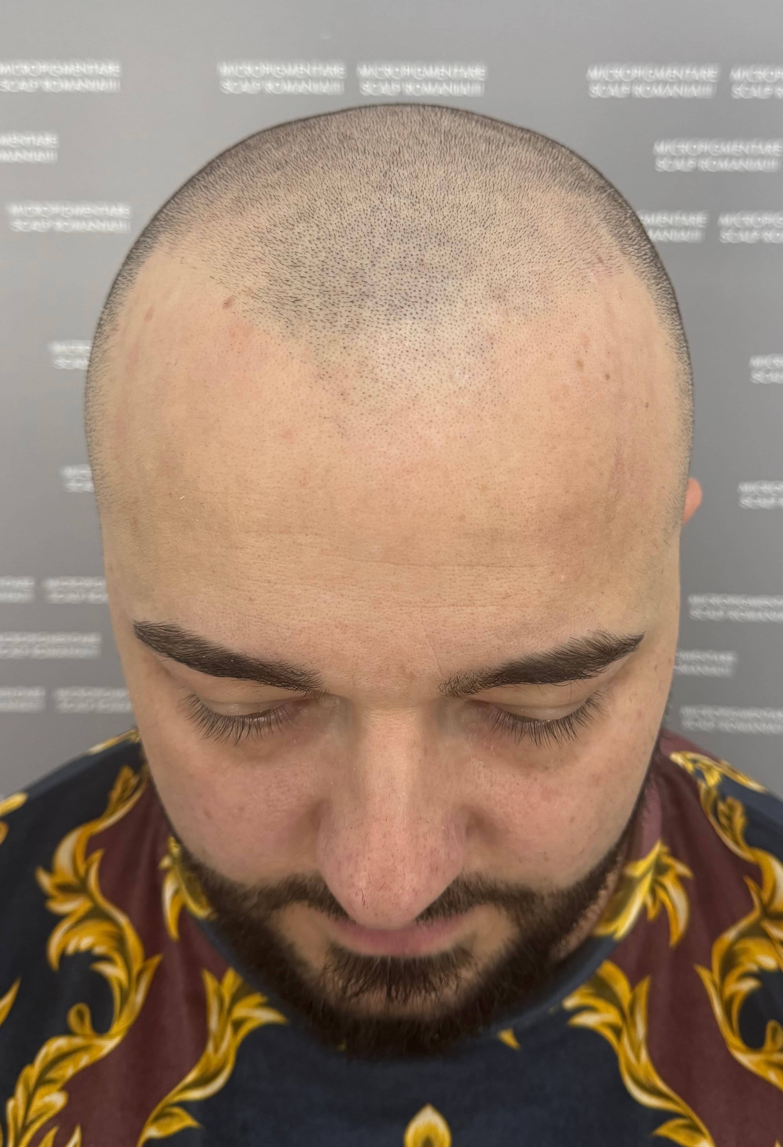 Înainte de micropigmentare scalp - Alopecie Androgenetică