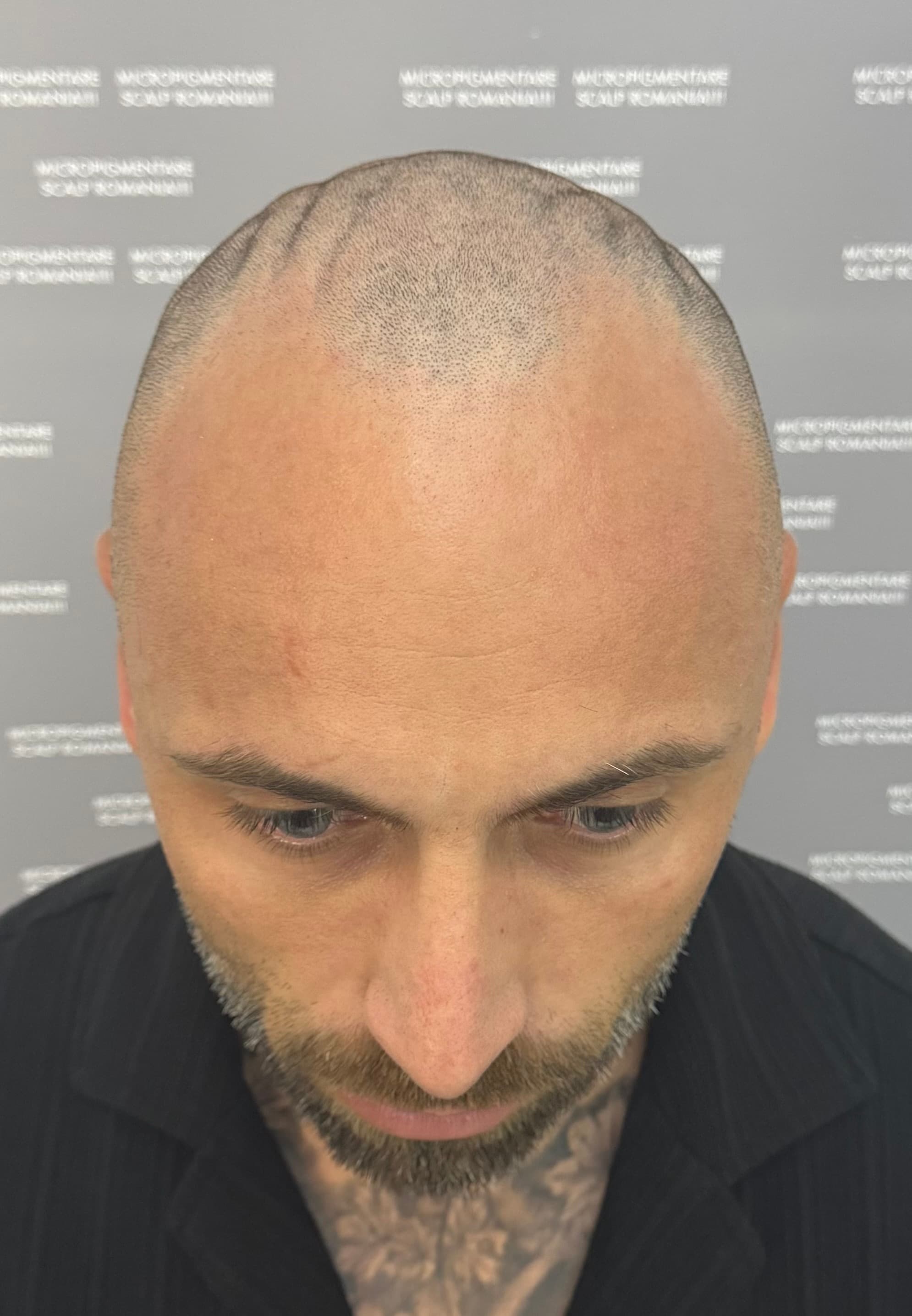 Înainte de micropigmentare scalp - Alopecie Androgenetică