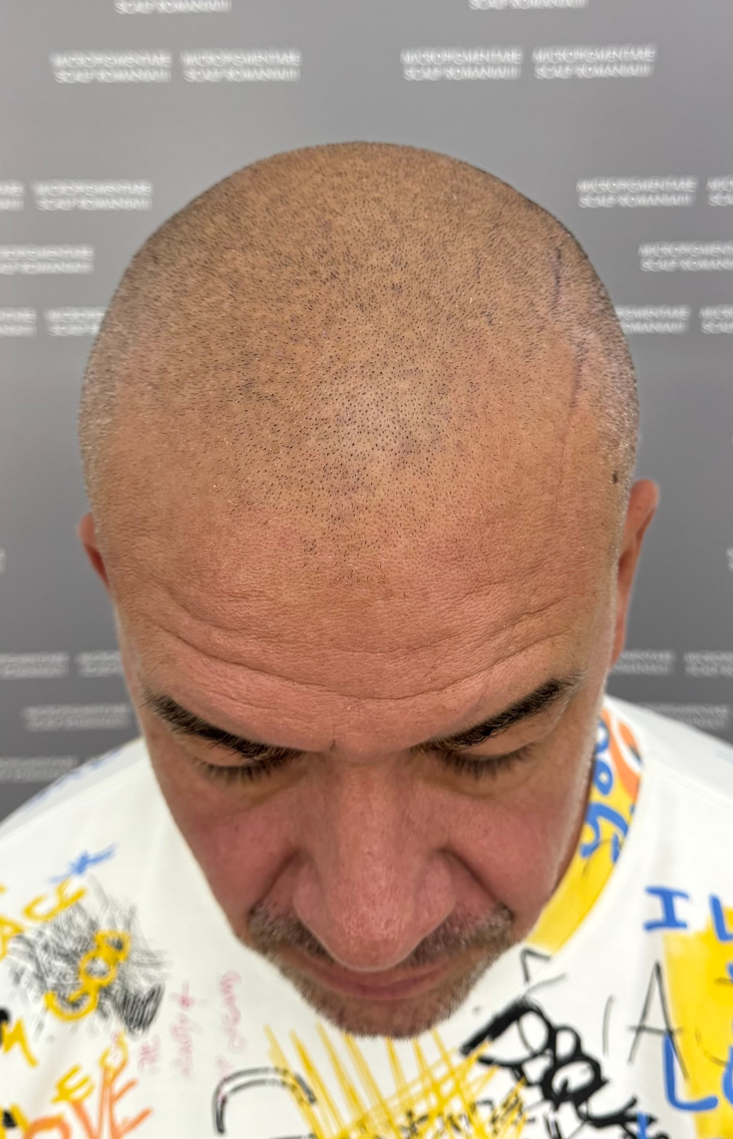 Înainte de micropigmentare scalp - Alopecie Androgenetică