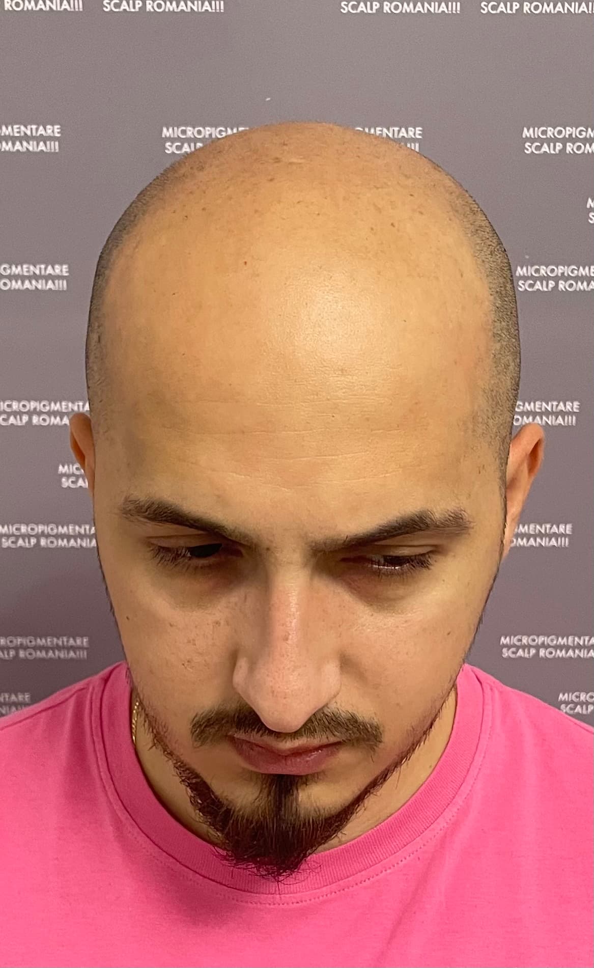 Înainte de micropigmentare scalp - Alopecie Androgenetică