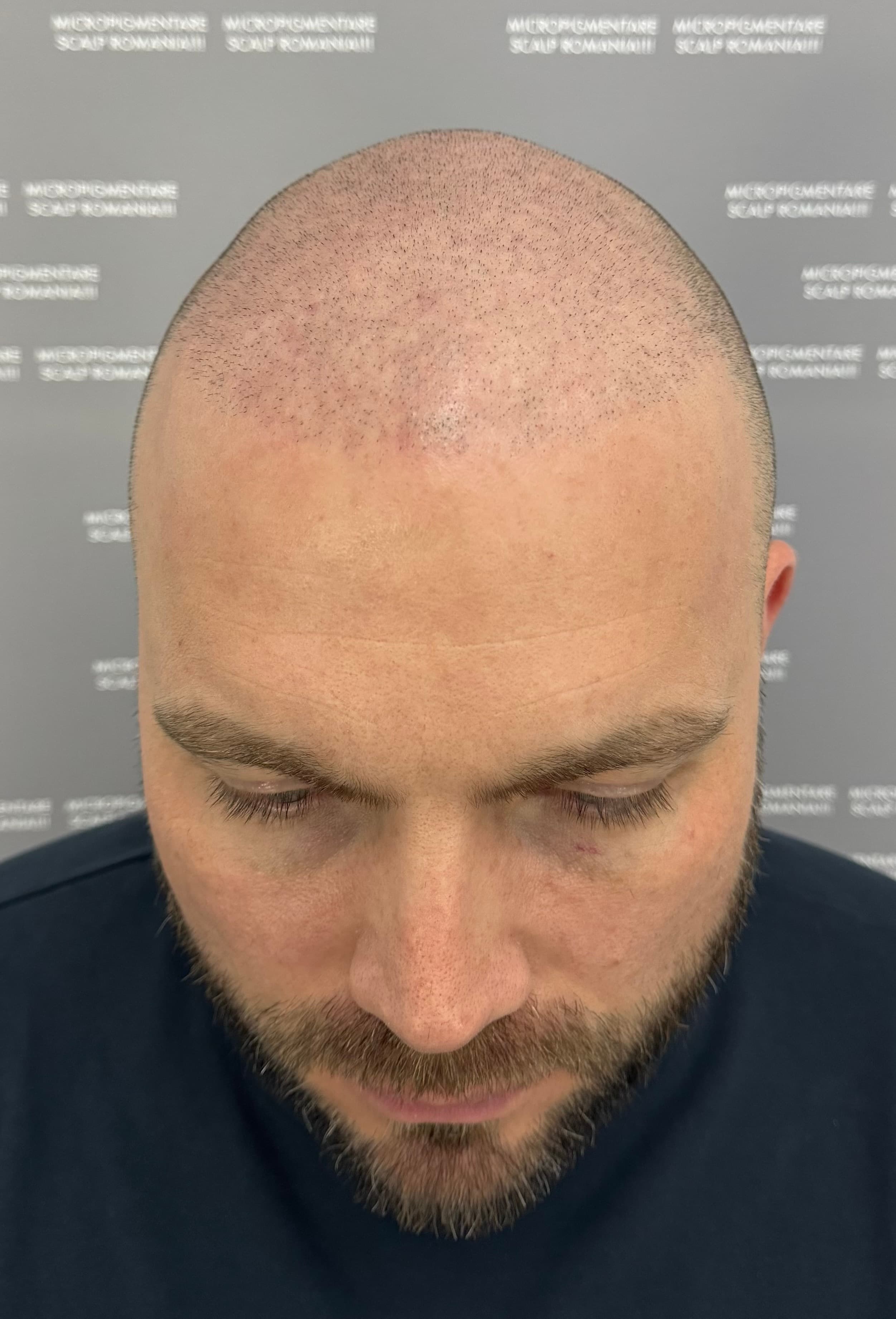 Înainte de micropigmentare scalp - Densitate Post Transplant