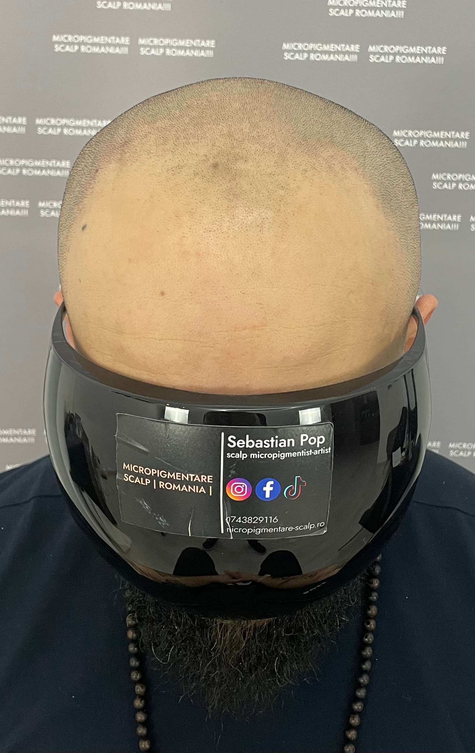 Înainte de micropigmentare scalp - Alopecie Androgenetică