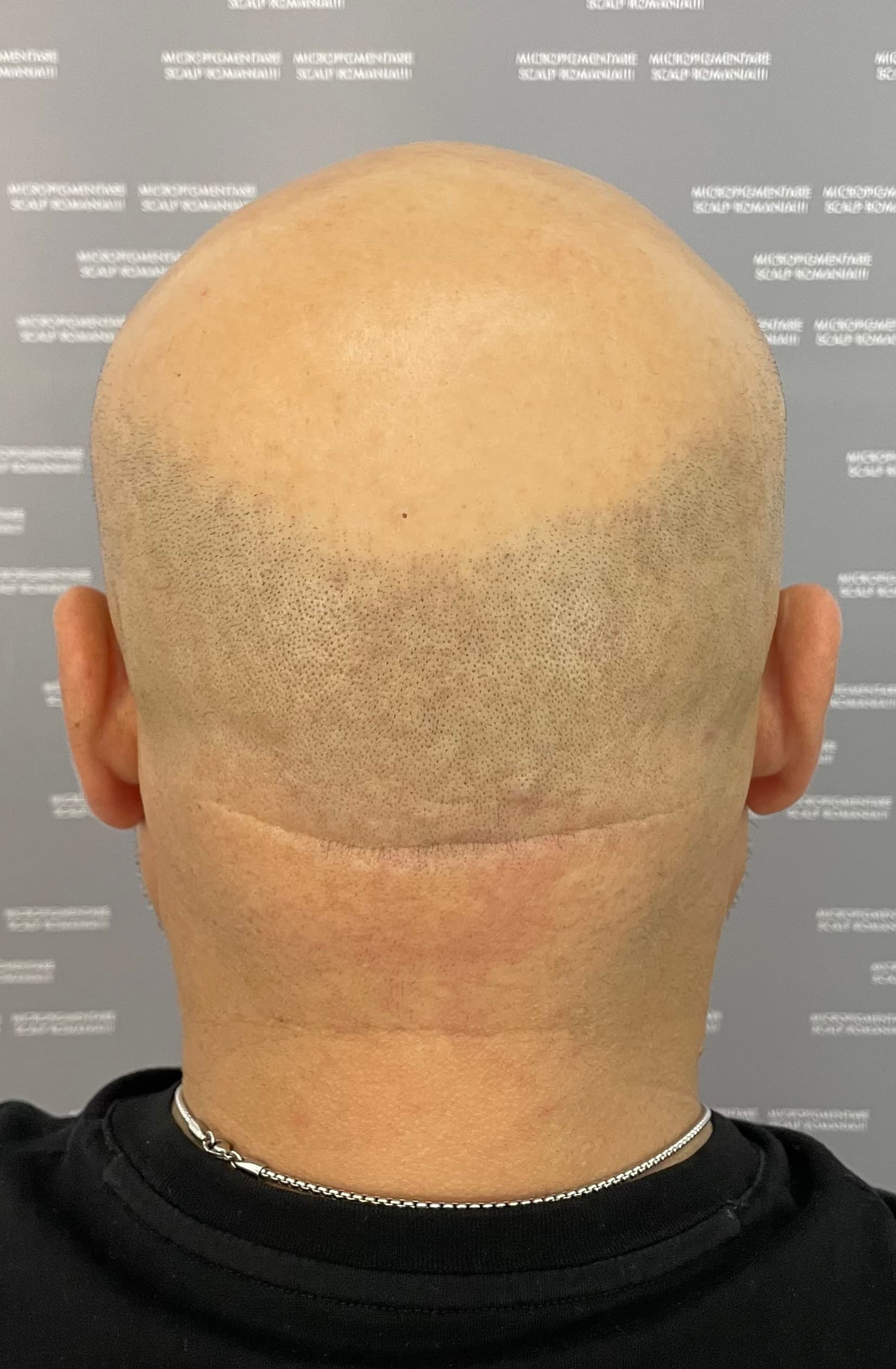Înainte de micropigmentare scalp - Alopecie Androgenetică