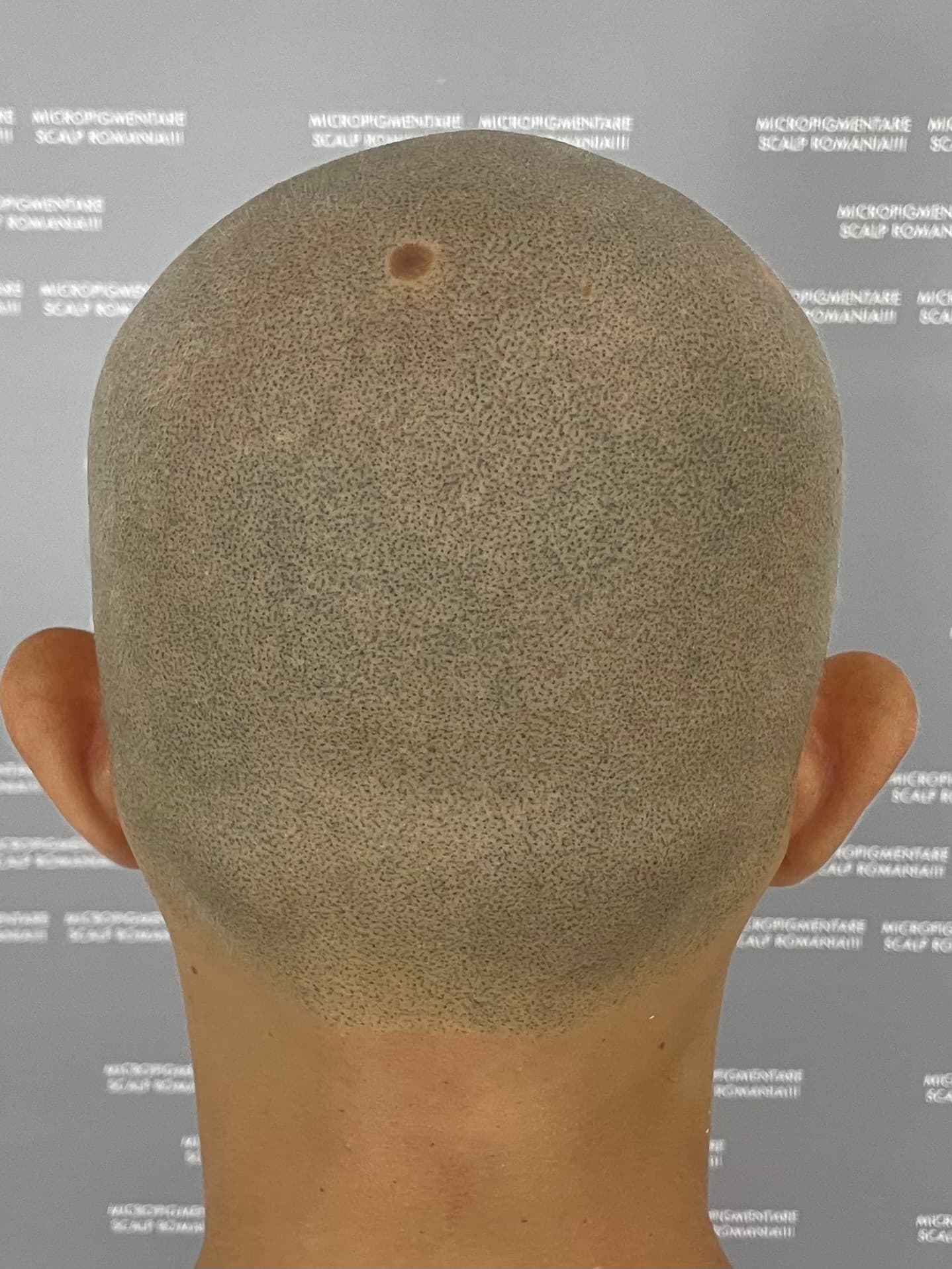 După micropigmentare scalp - Alopecie Areată
