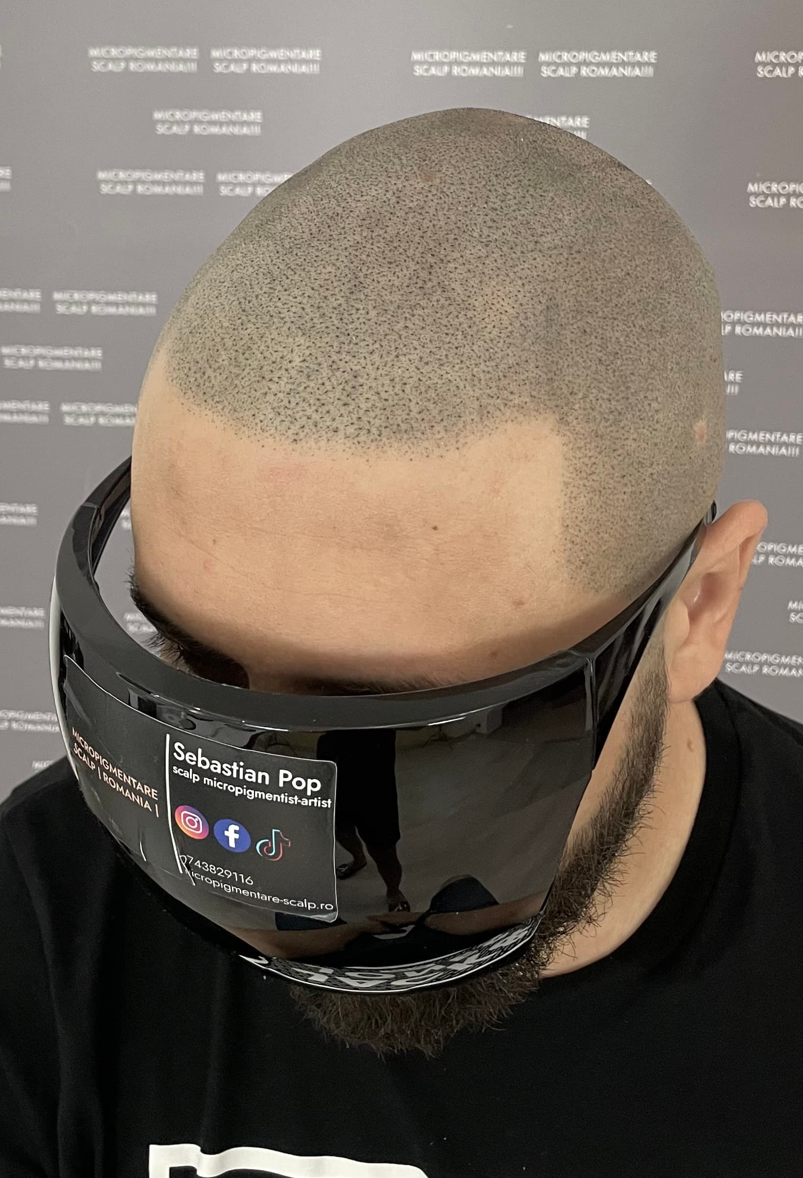 După micropigmentare scalp - Alopecie Areată