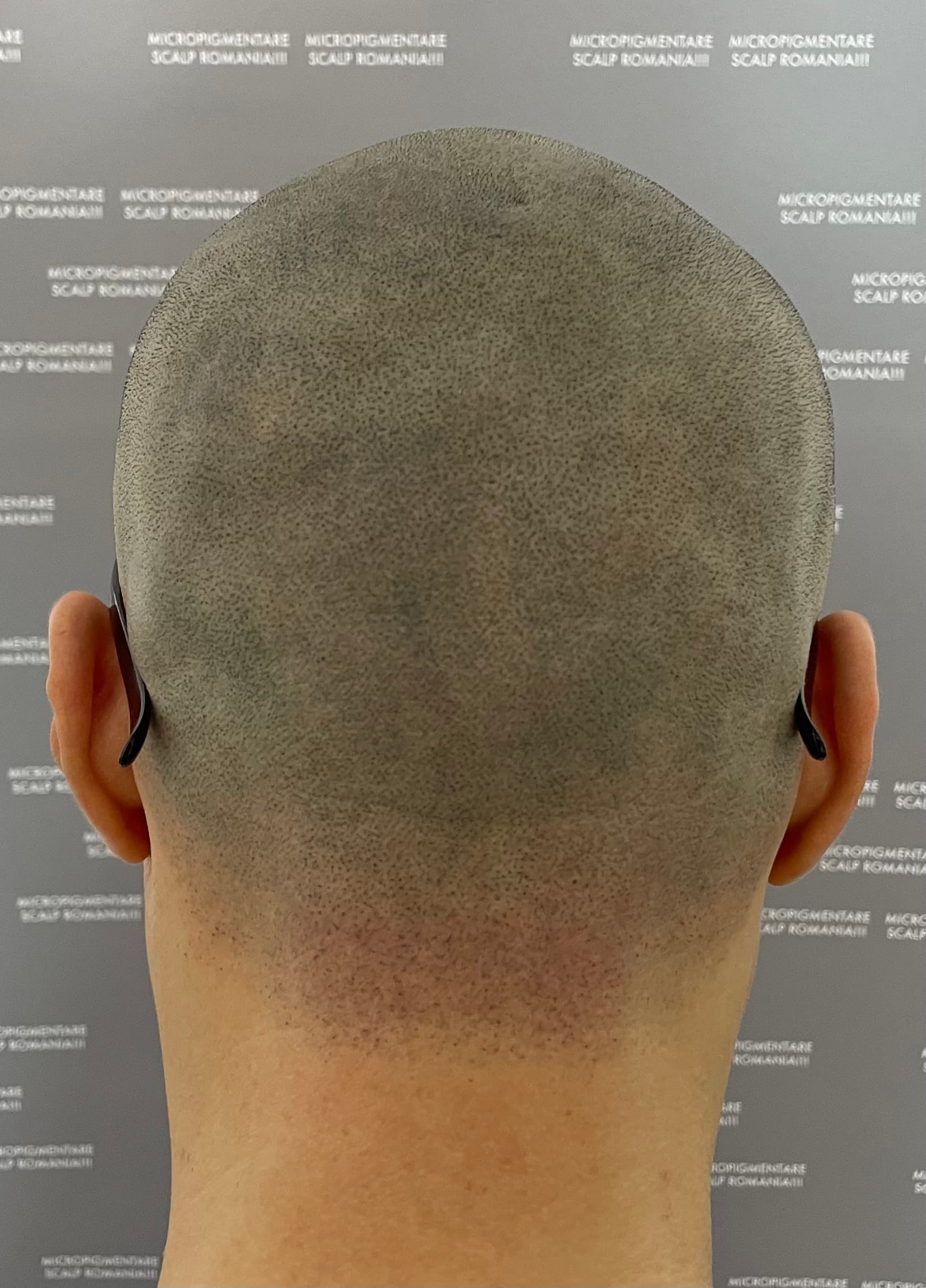 După micropigmentare scalp - Alopecie Areată
