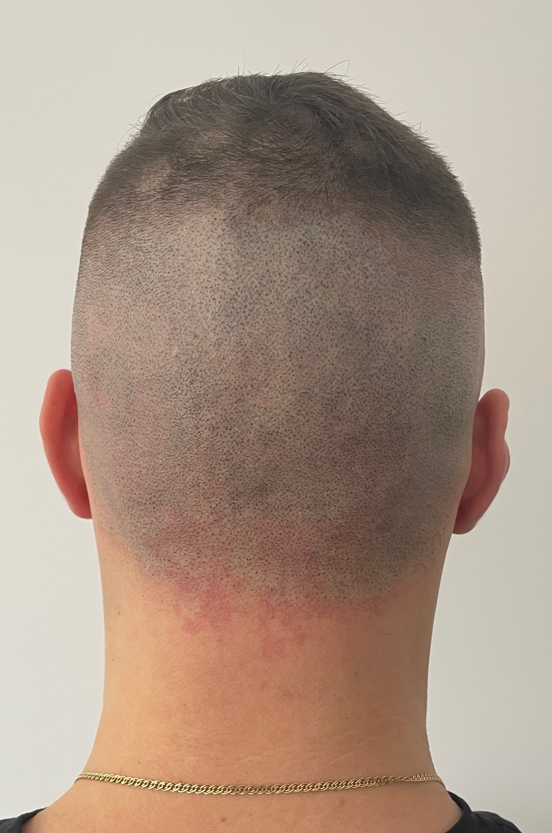 După micropigmentare scalp - Alopecie Areată