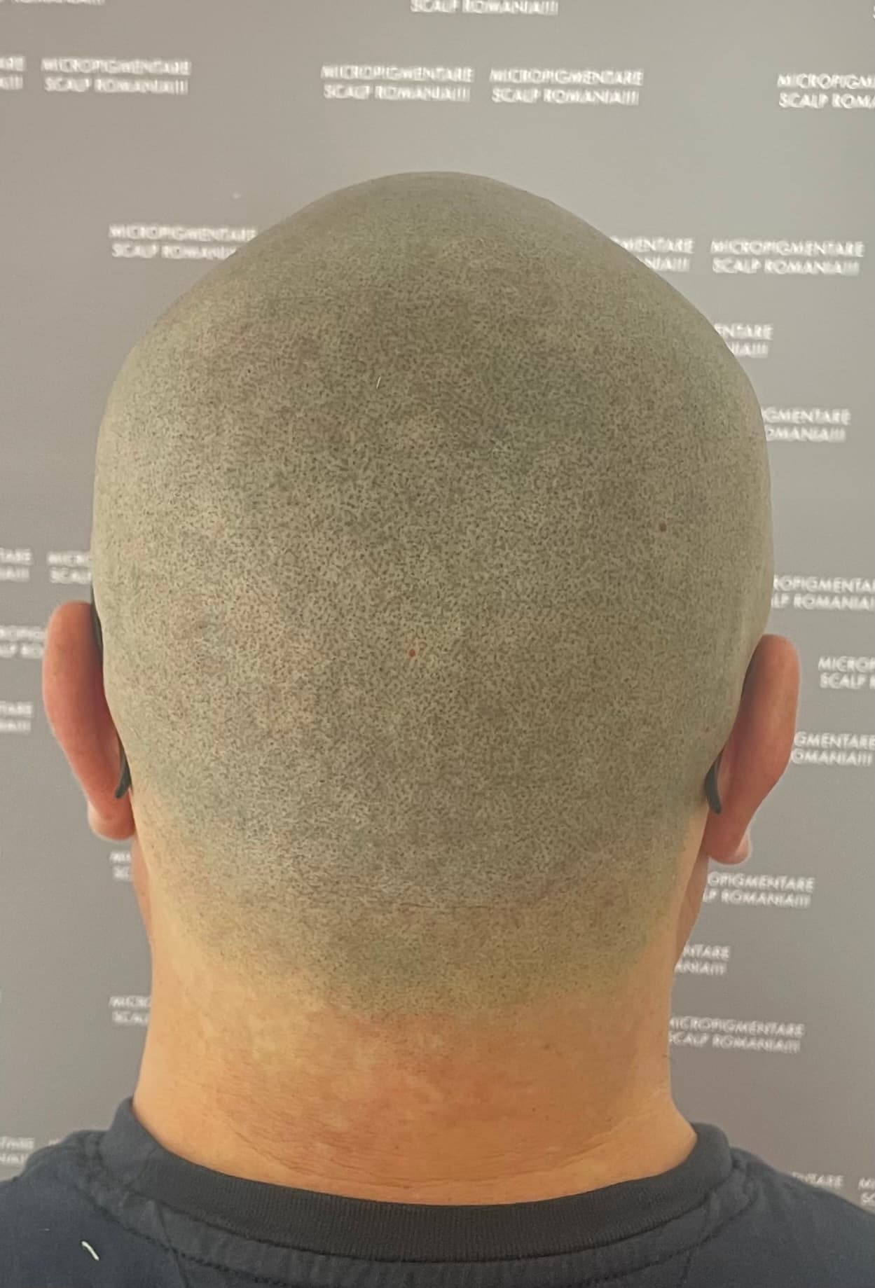 După micropigmentare scalp - Alopecie Areată