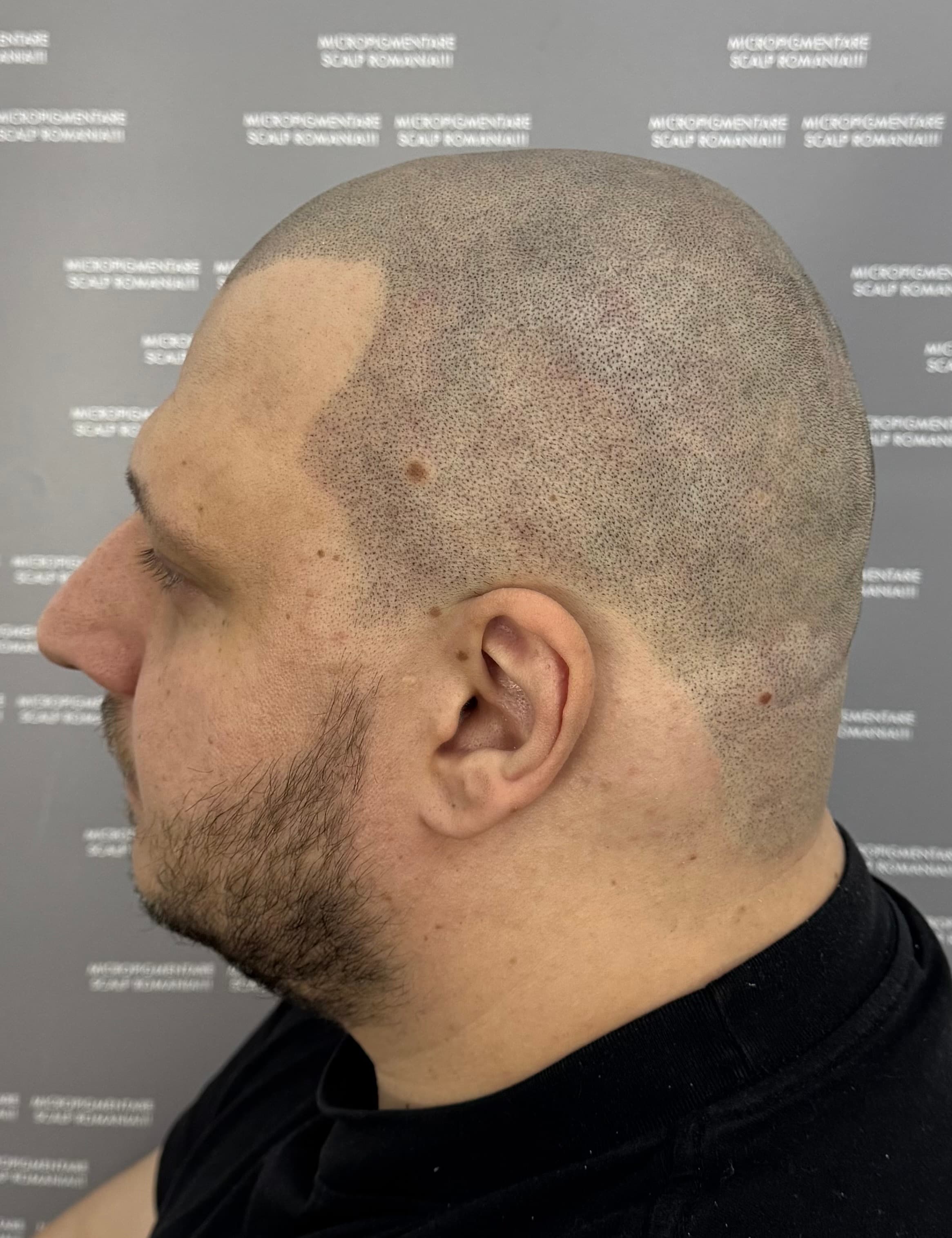 După micropigmentare scalp - Alopecie Areată