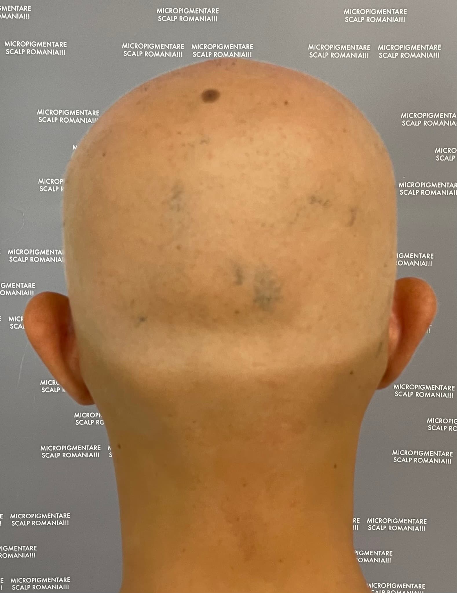 Înainte de micropigmentare scalp - Alopecie Areată
