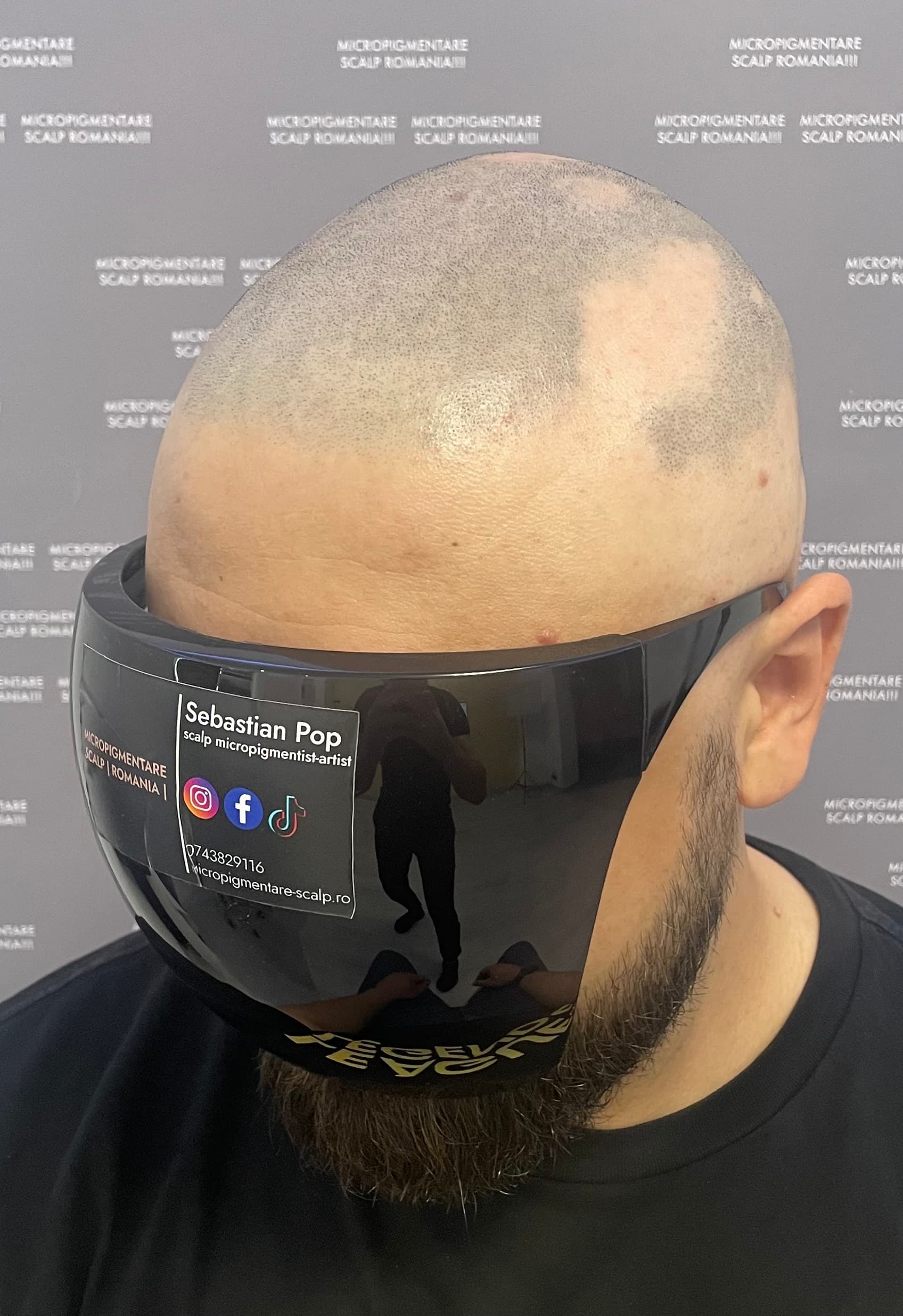 Înainte de micropigmentare scalp - Alopecie Areată