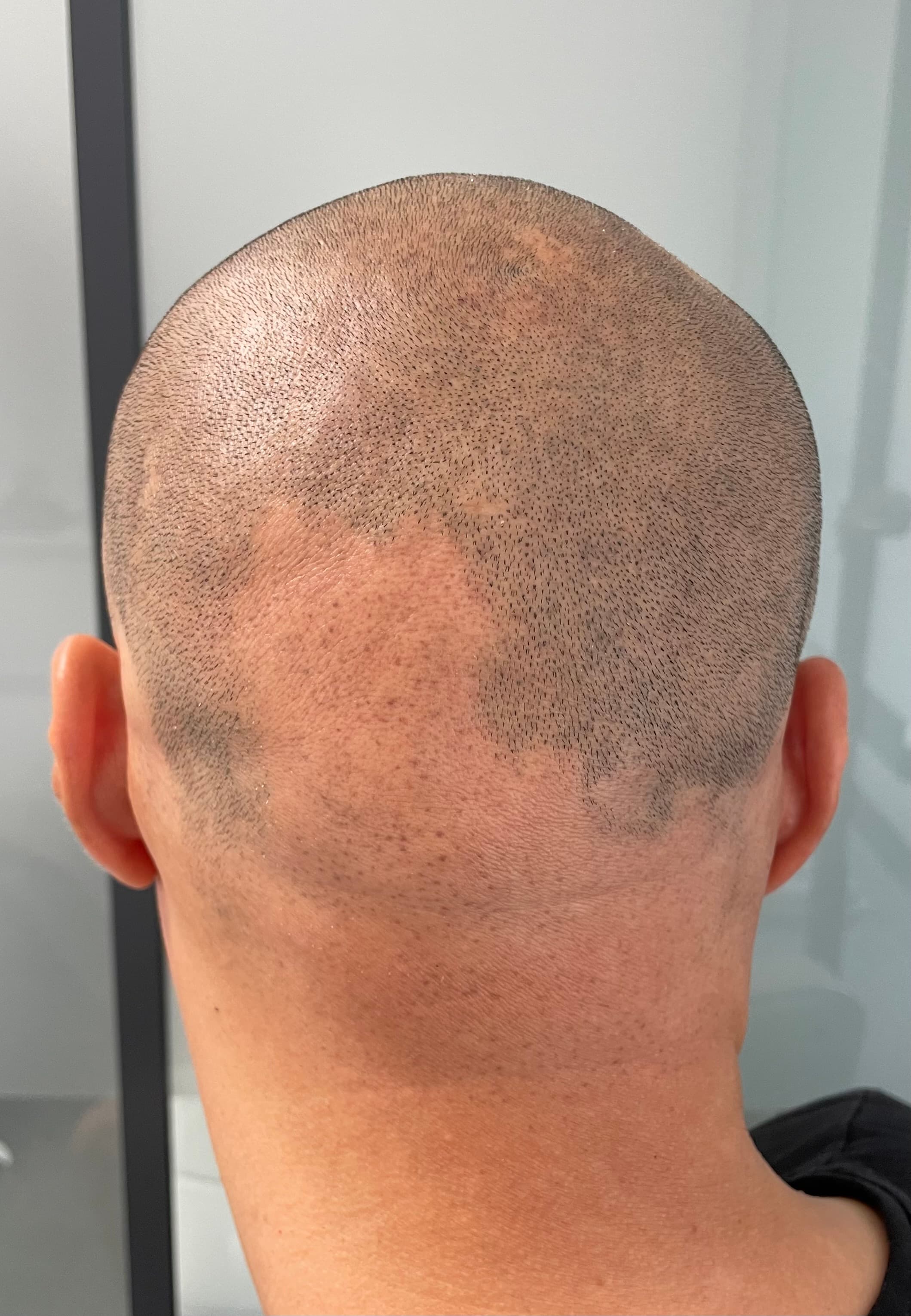 Înainte de micropigmentare scalp - Alopecie Areată